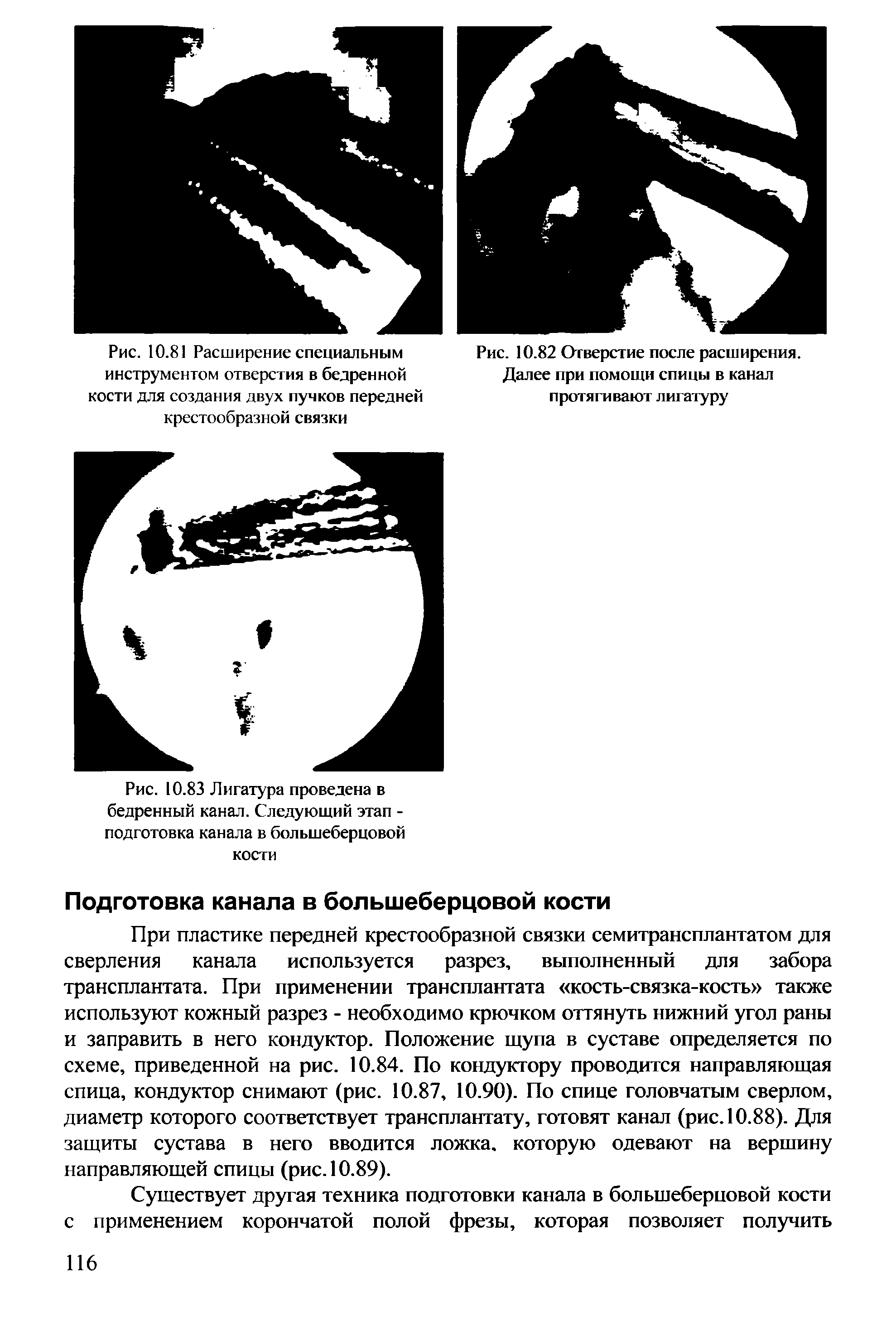 Рис. 10.83 Лигатура проведена в бедренный канал. Следующий этап -подготовка канала в большеберцовой кости...