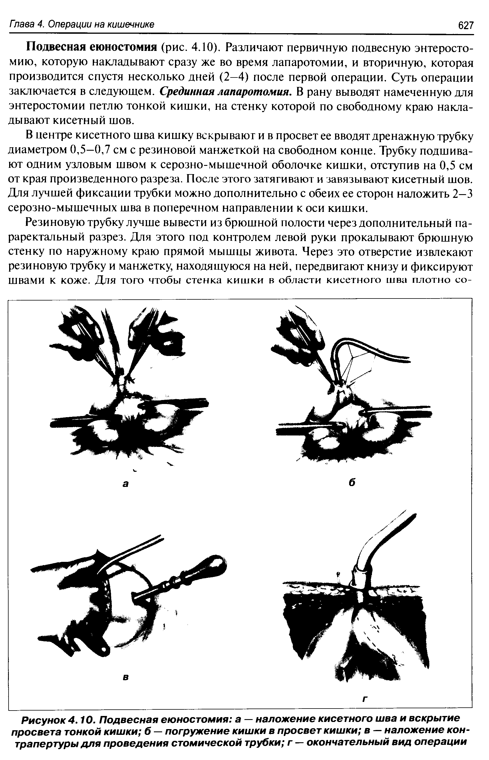 Рисунок4.10. Подвесная еюностомия а — наложение кисетного шва и вскрытие просвета тонкой кишки б — погружение кишки в просвет кишки в — наложение контрапертуры для проведения стомической трубки г — окончательный вид операции...