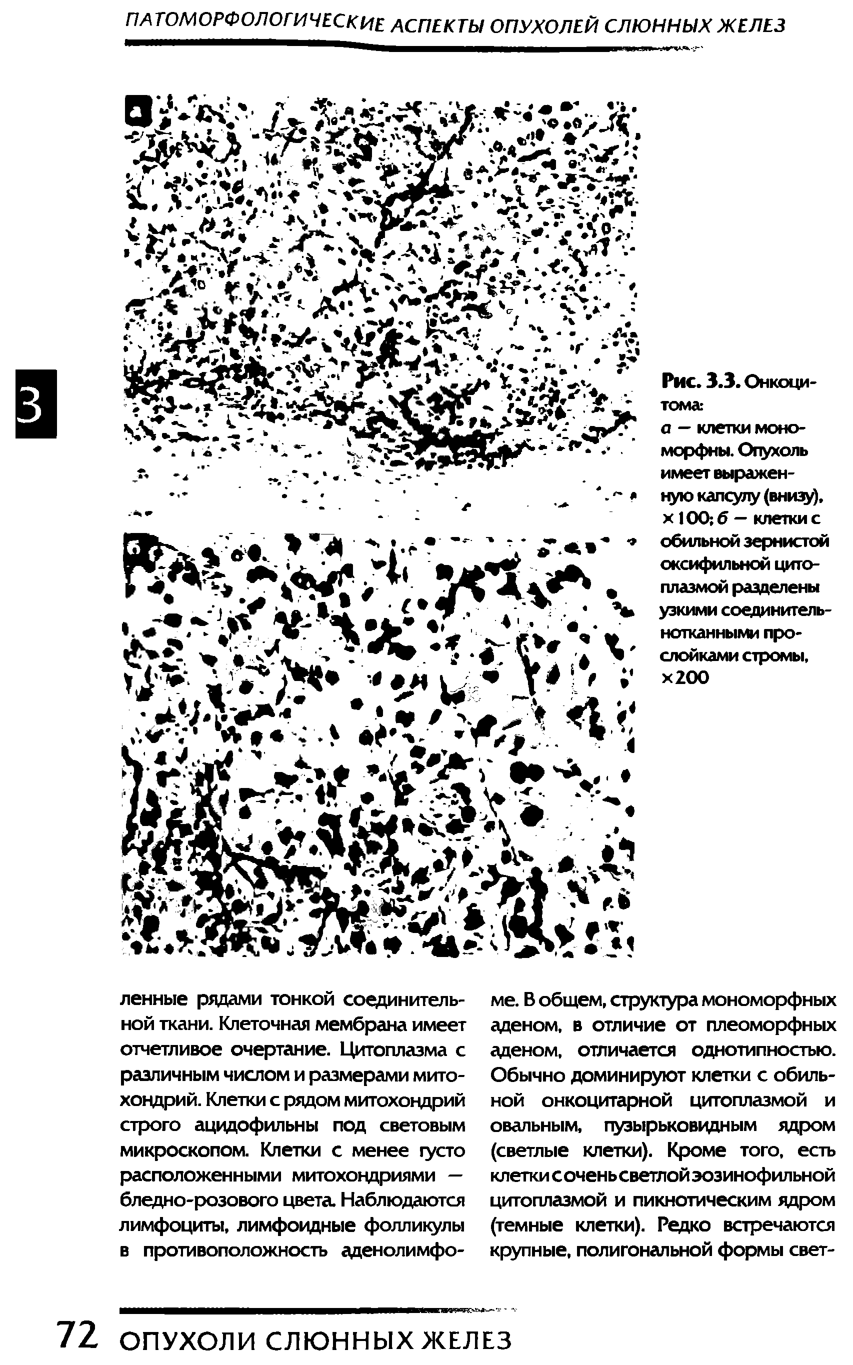 Рис. 3.3. Онкоцитома.-а — клетки моно-морфны. Опухоль имеет выраженную капсулу (внизу), х 100 б — клетки с обильной зернистой оксифильной цитоплазмой разделены узкими соединительнотканными прослойками стромы, х200...