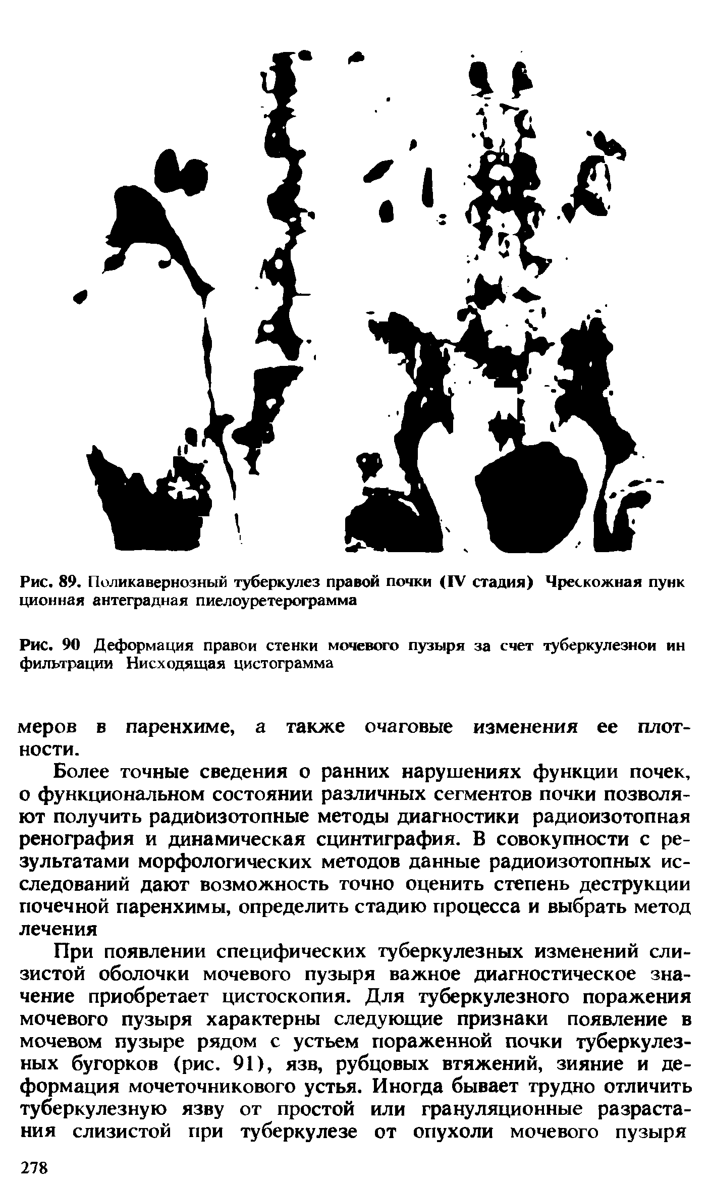 Рис. 90 Деформация правой стенки мочевого пузыря за счет туберкулезной ин фильтрации Нисходящая цистограмма...