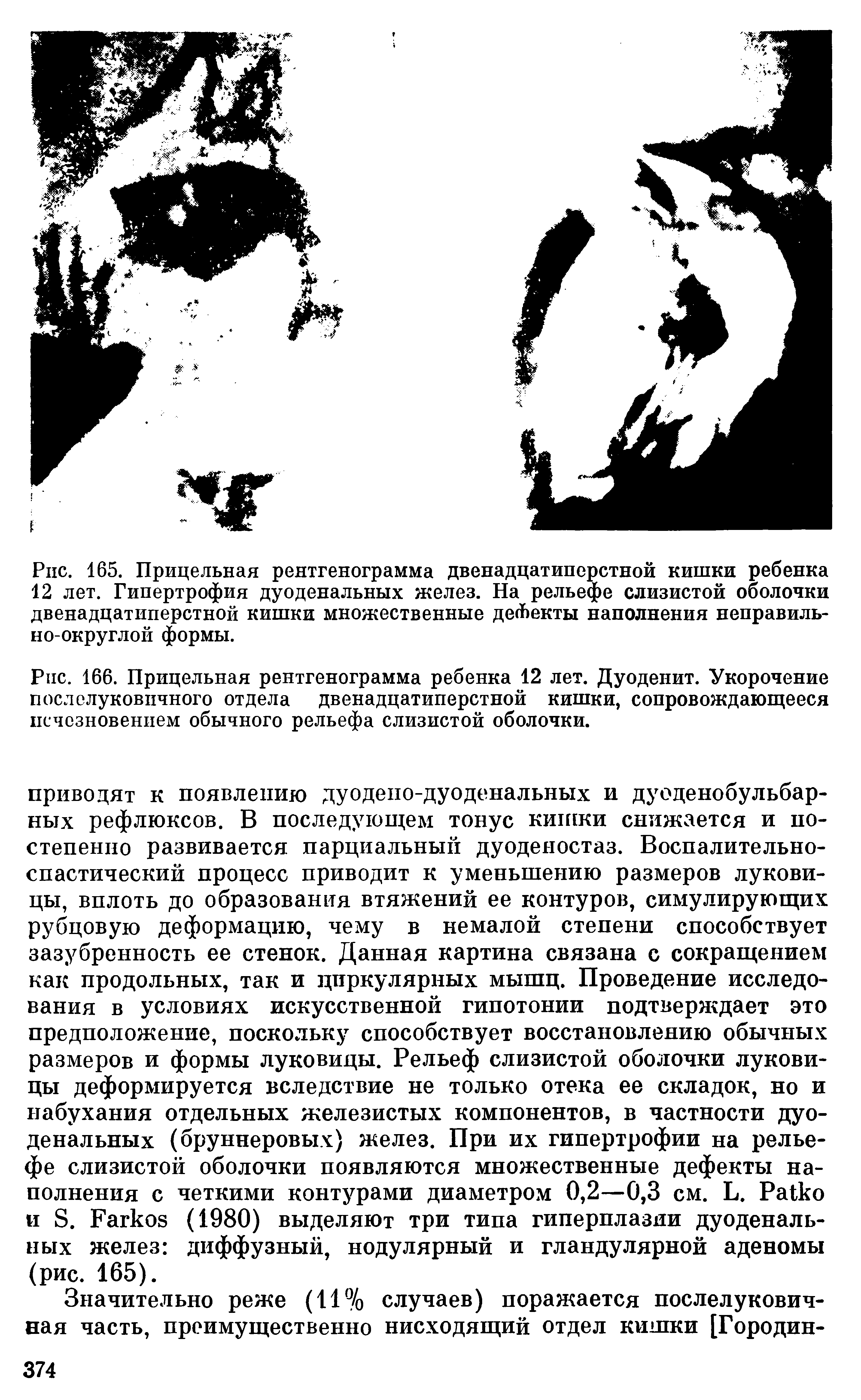 Рис. 166. Прицельная рентгенограмма ребенка 12 лет. Дуоденит. Укорочение после луковичного отдела двенадцатиперстной кишки, сопровождающееся исчезновением обычного рельефа слизистой оболочки.