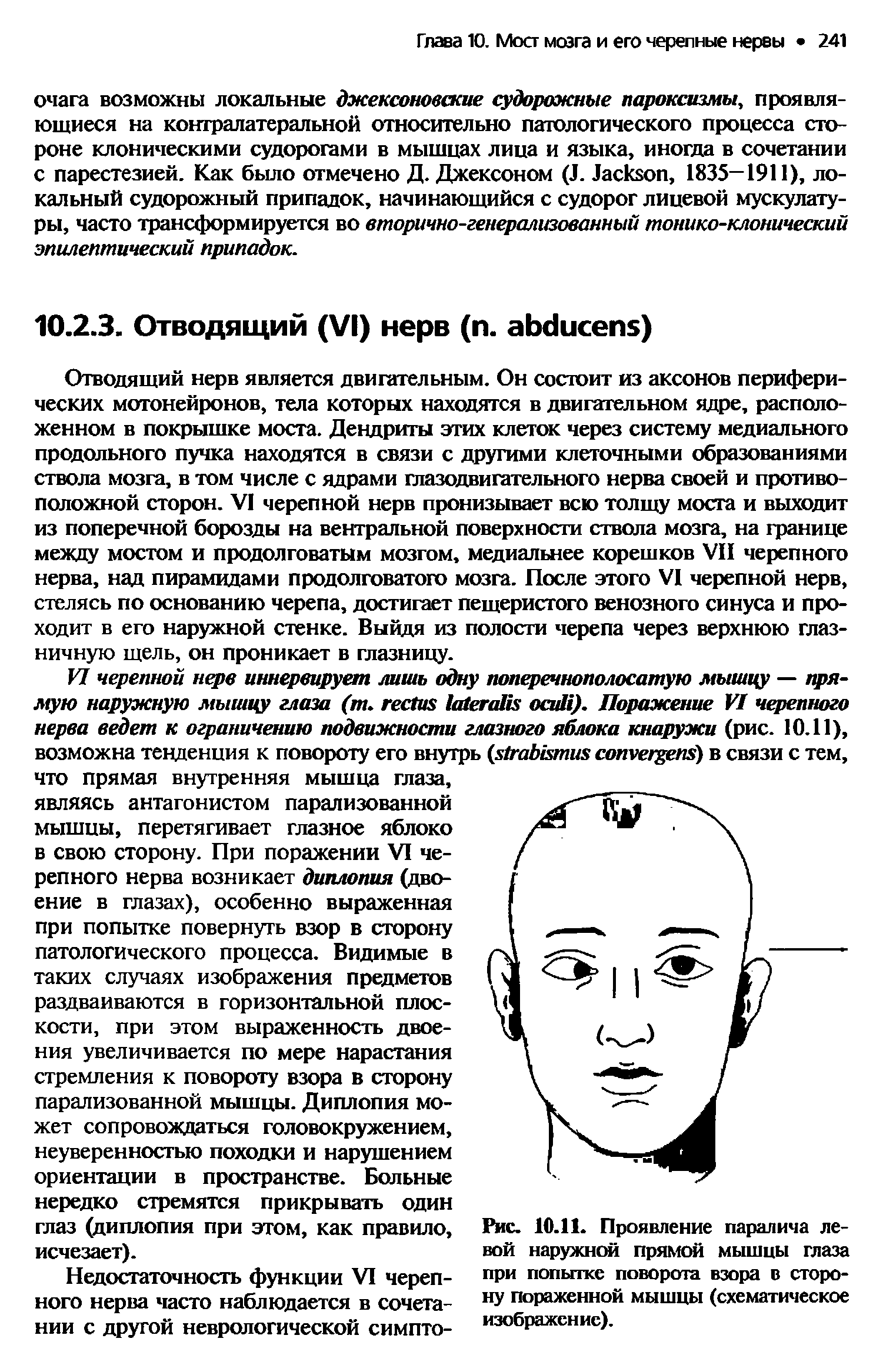 Рис. 10.11. Проявление паралича левой наружной прямой мышцы глаза при попытке поворота взора в сторону пораженной мышцы (схематическое изображение).