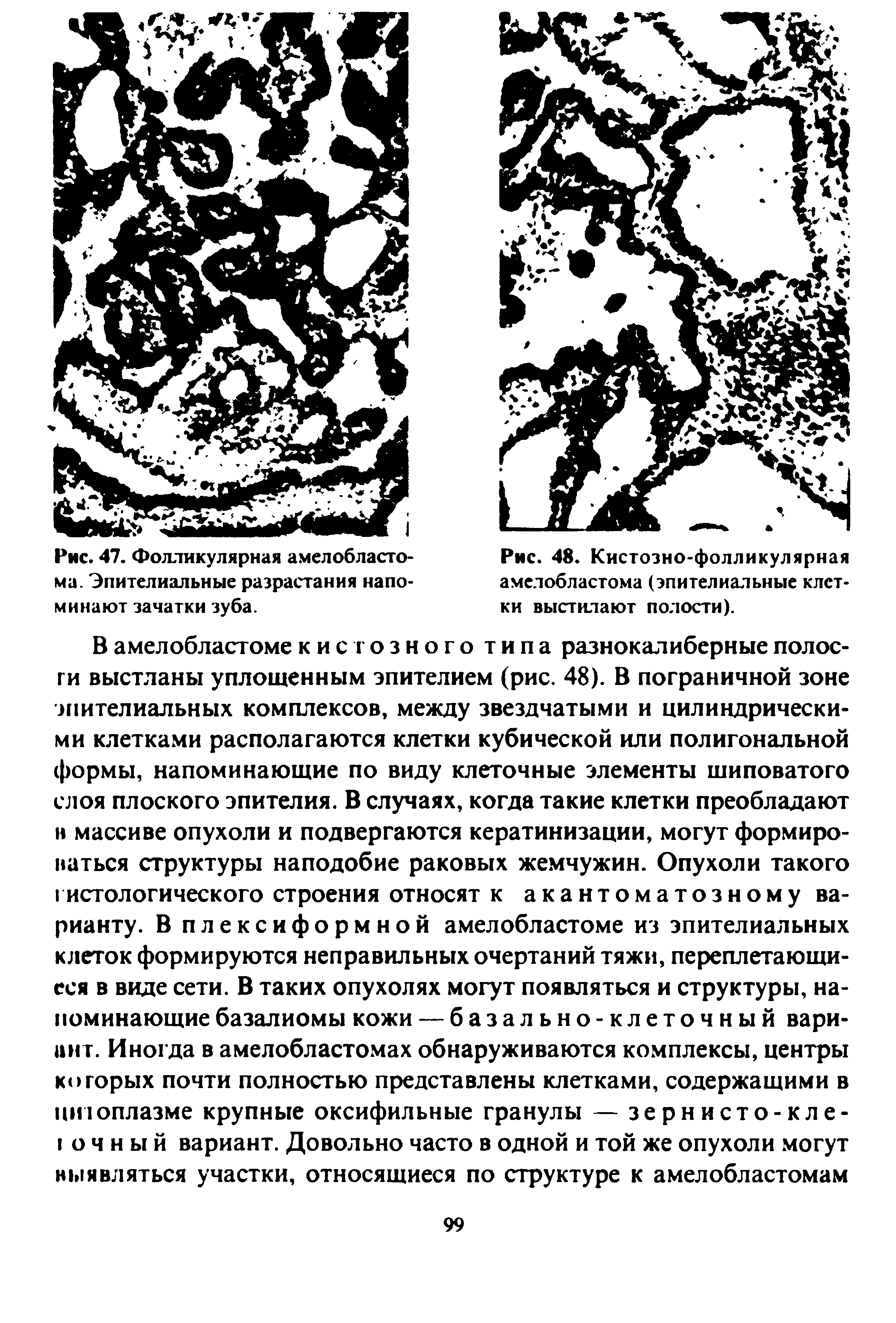 Рис. 48. Кистозно-фолликулярная амелобластома (эпителиальные клетки выстилают полости).