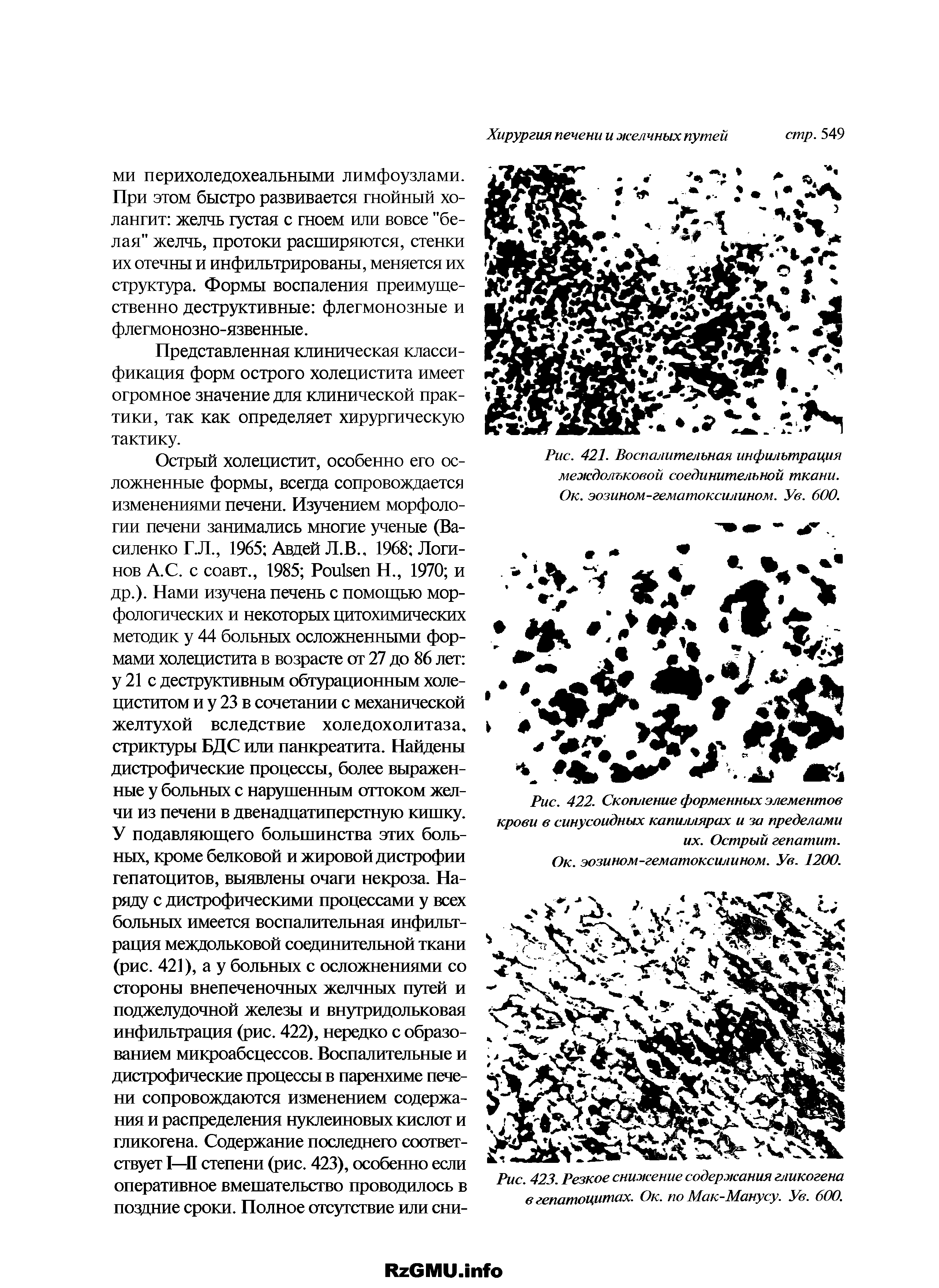 Рис. 423. Резкое снижение содержания гликогена в гепатоцитах. Ок. по Мак-Манусу. Ув. 600.