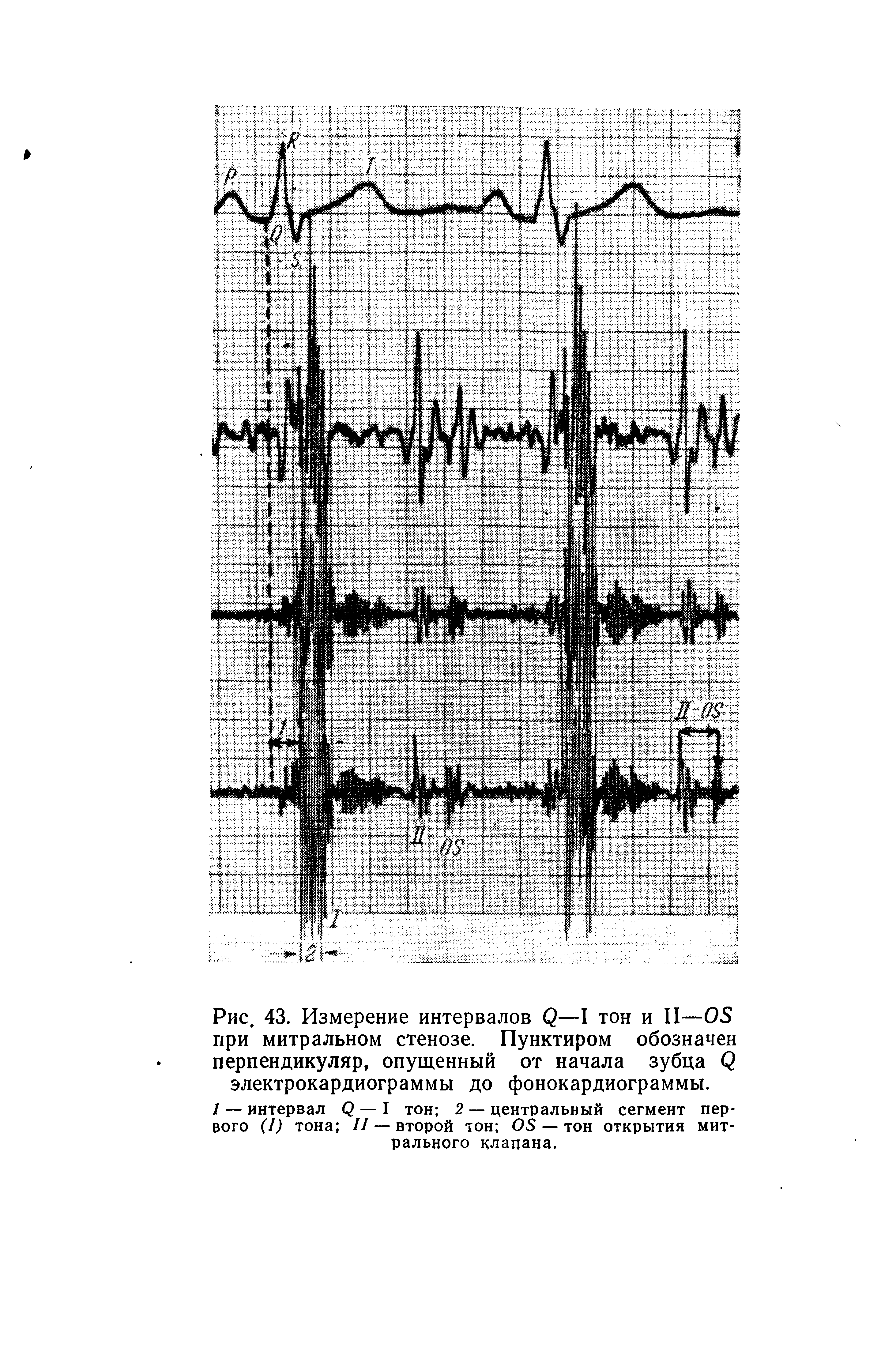 Рис. 43. Измерение интервалов <2—I тон и II—ОЗ при митральном стенозе. Пунктиром обозначен перпендикуляр, опущенный от начала зубца О электрокардиограммы до фонокардиограммы.