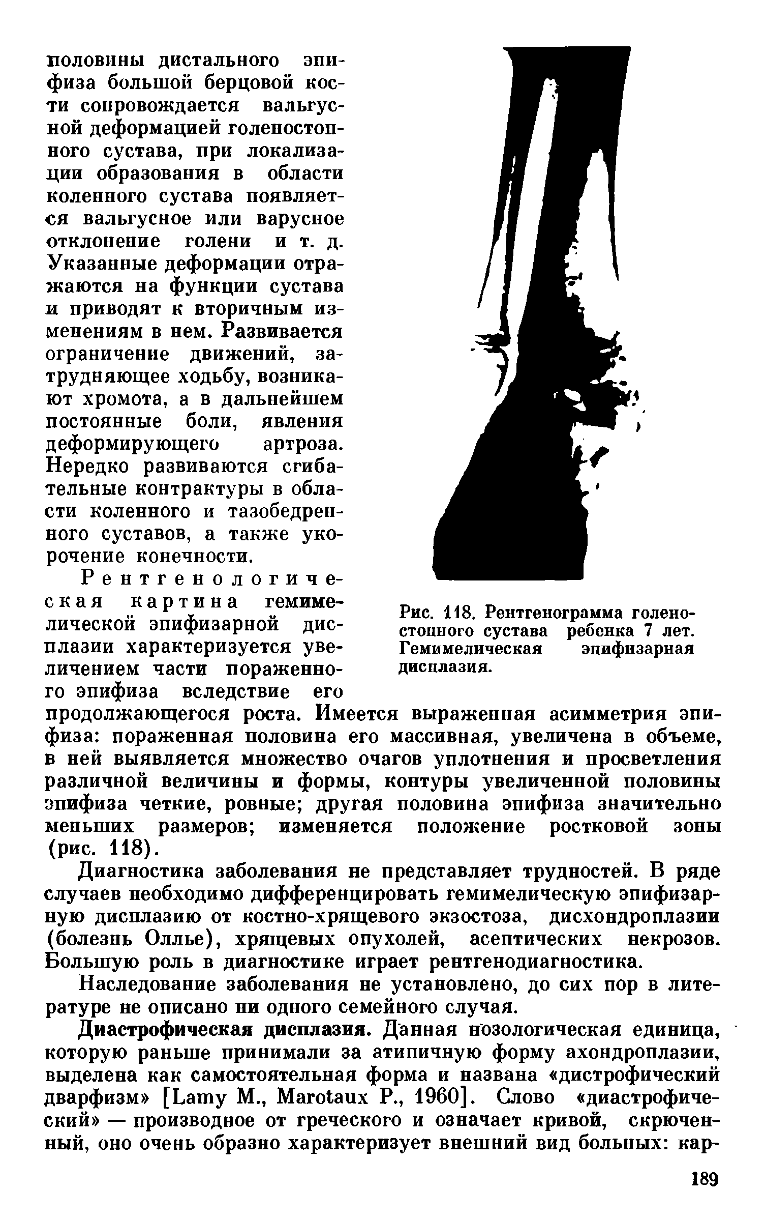 Рис. 118. Рентгенограмма стопного сустава Г емиме лическая дисплазия.