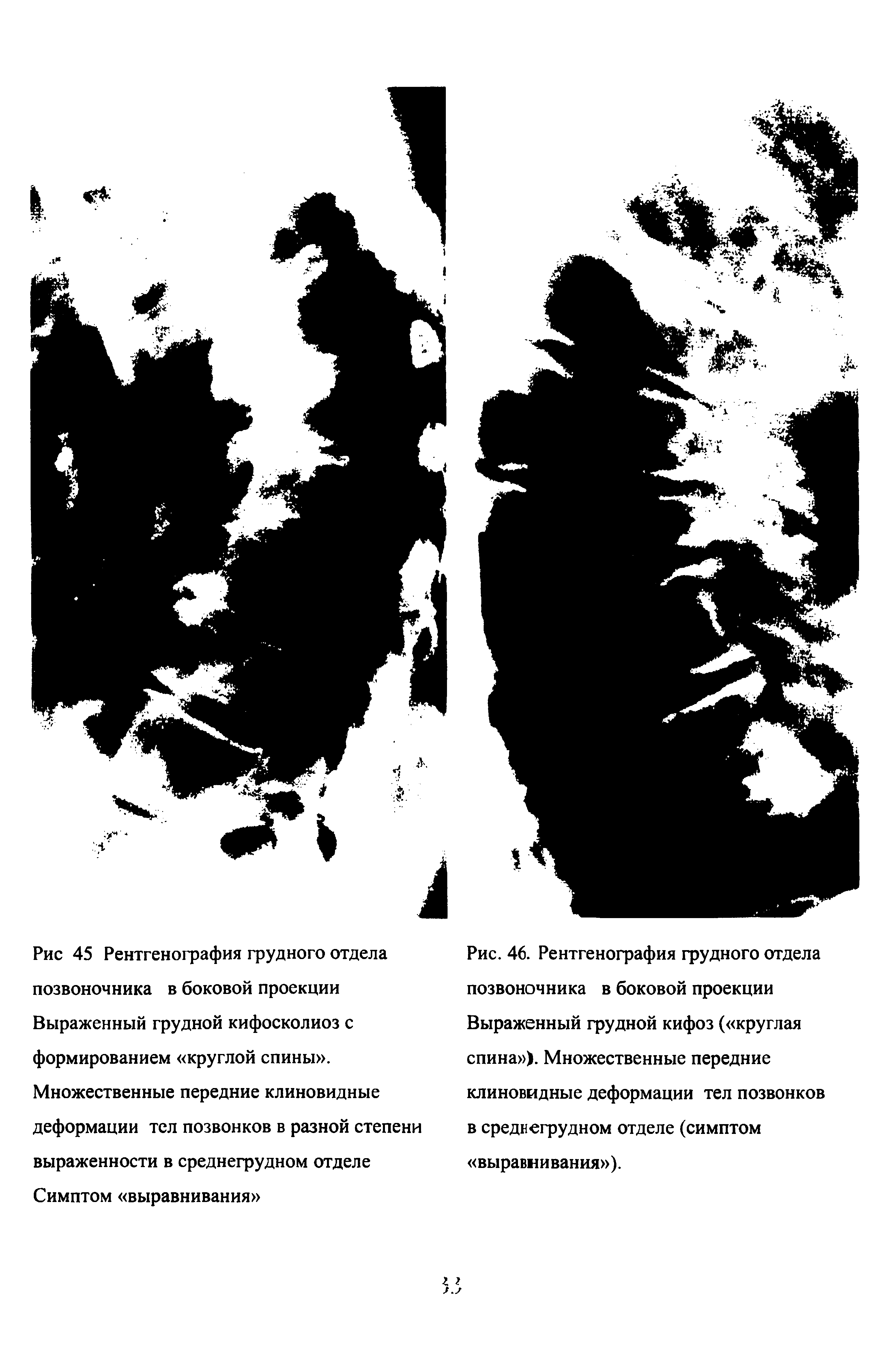 Рис. 46. Рентгенография грудного отдела позвоночника в боковой проекции Выраженный грудной кифоз ( круглая спина ). Множественные передние клиновидные деформации тел позвонков в среднегрудном отделе (симптом выравнивания ).