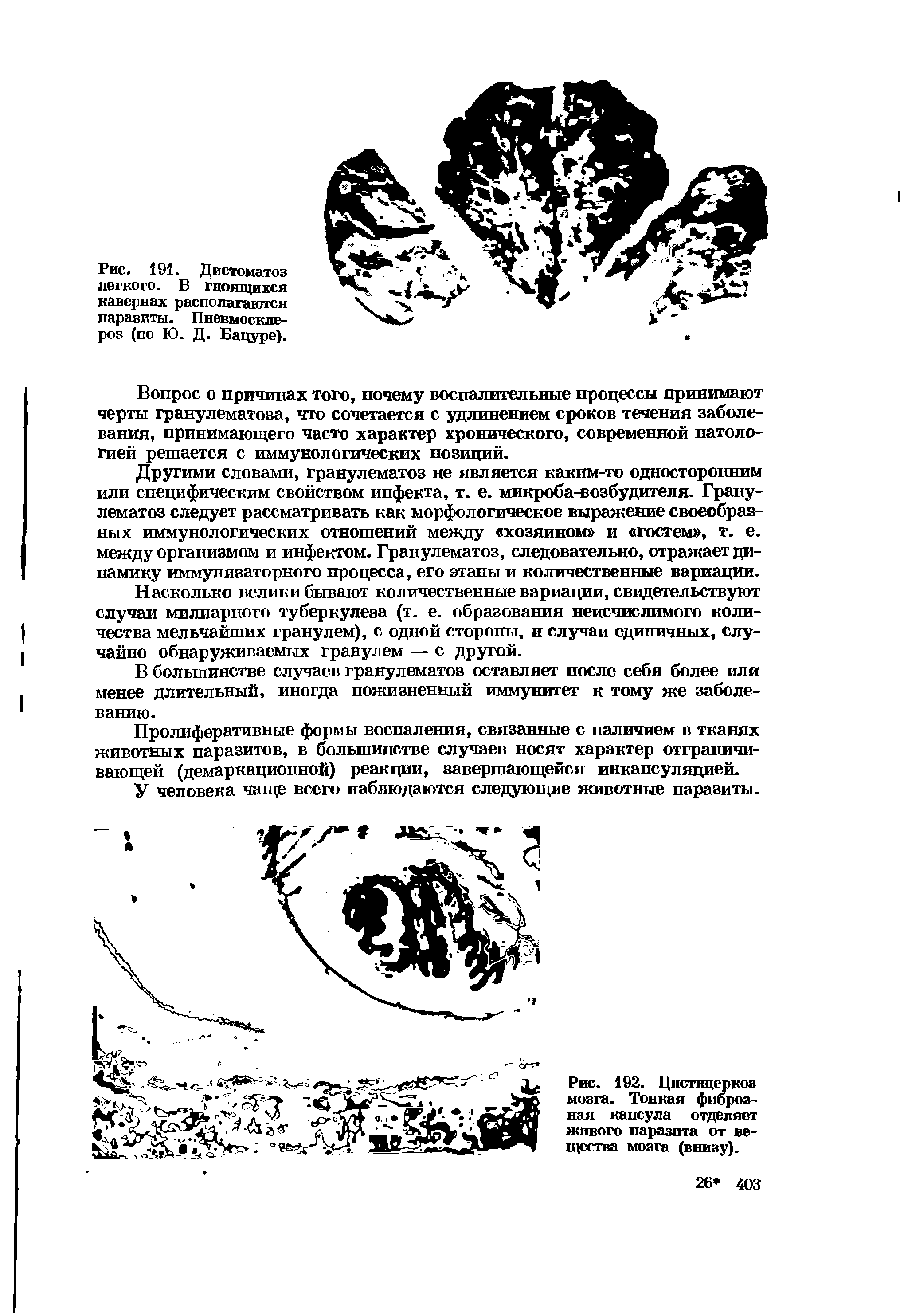 Рис. 192. Цистицеркоз мозга. Тонкая фиброзная капсула отделяет живого паразита от вещества мозга (внизу).