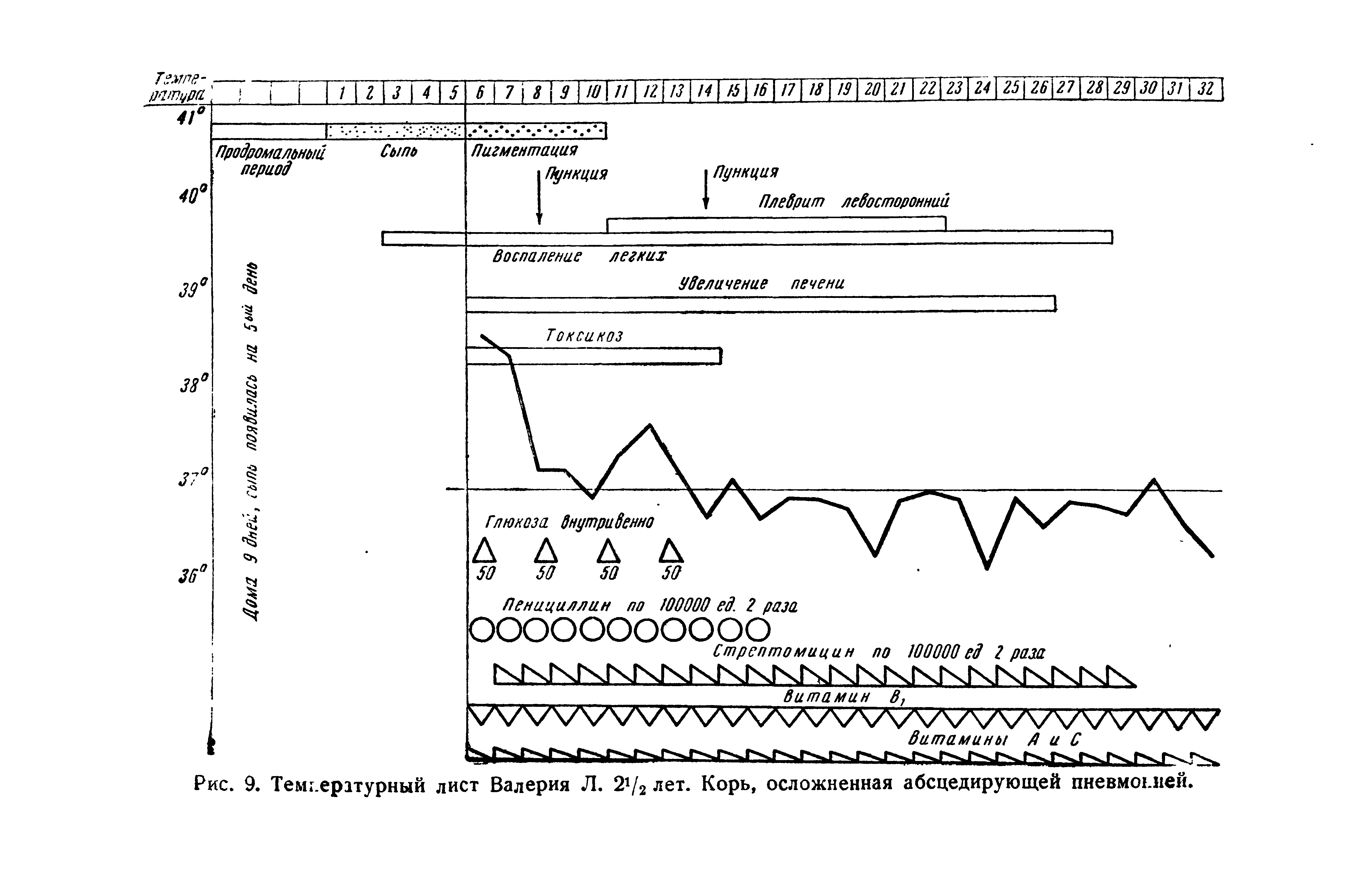 Рис. 9. Температурный лист Валерия Л. 2>/2 лет. Корь, осложненная абсцедирующей пневмонией.