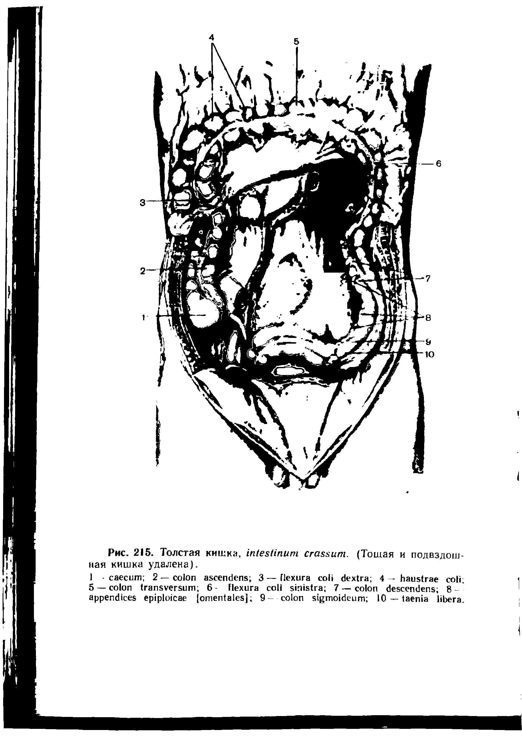 Рис. 215. Толстая кишка, . (Тошая и подвздошная кишка удалена).