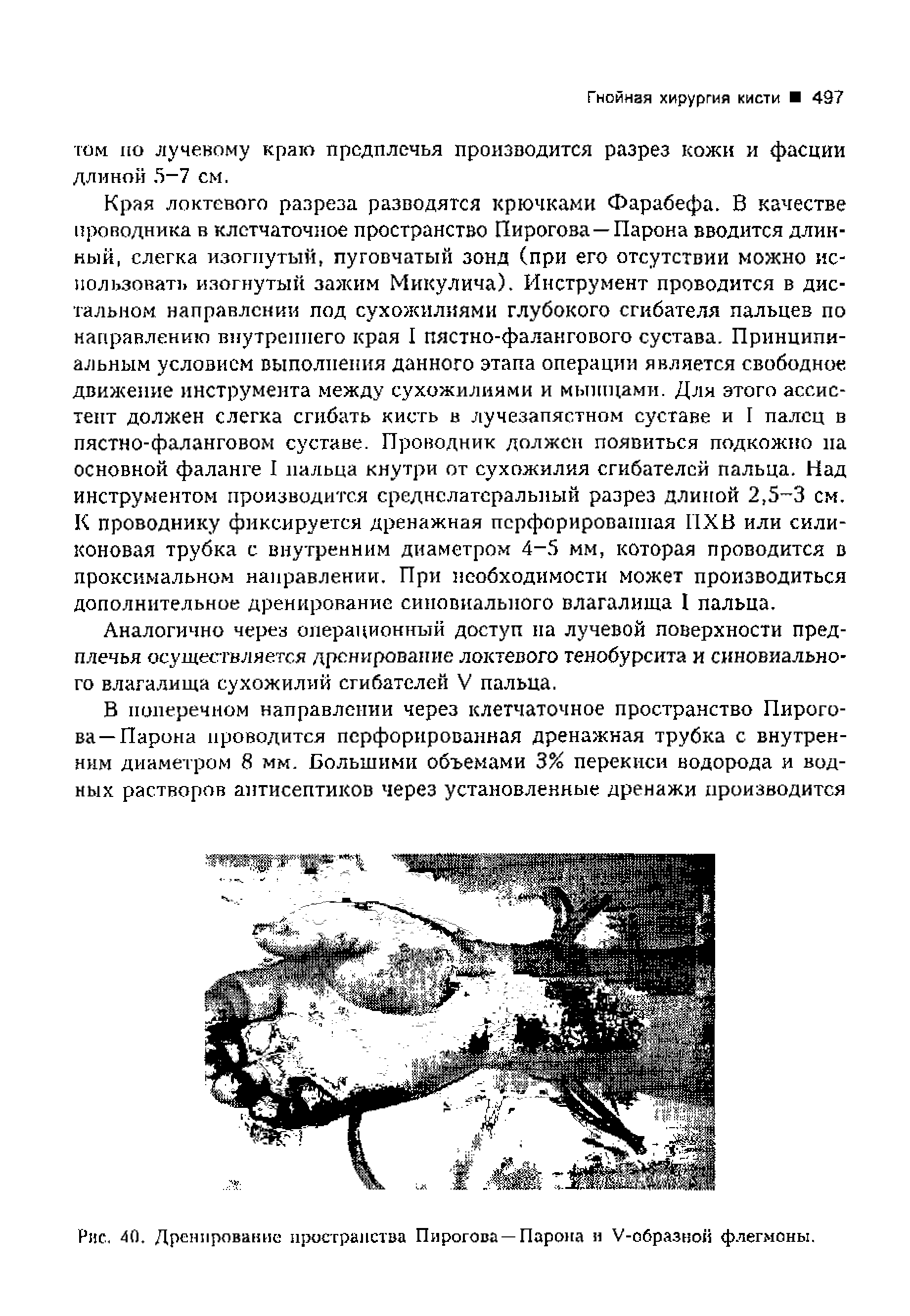 Рис. <10. Дренирование пространства Пирогова —Парона и У-образной флегмоны.