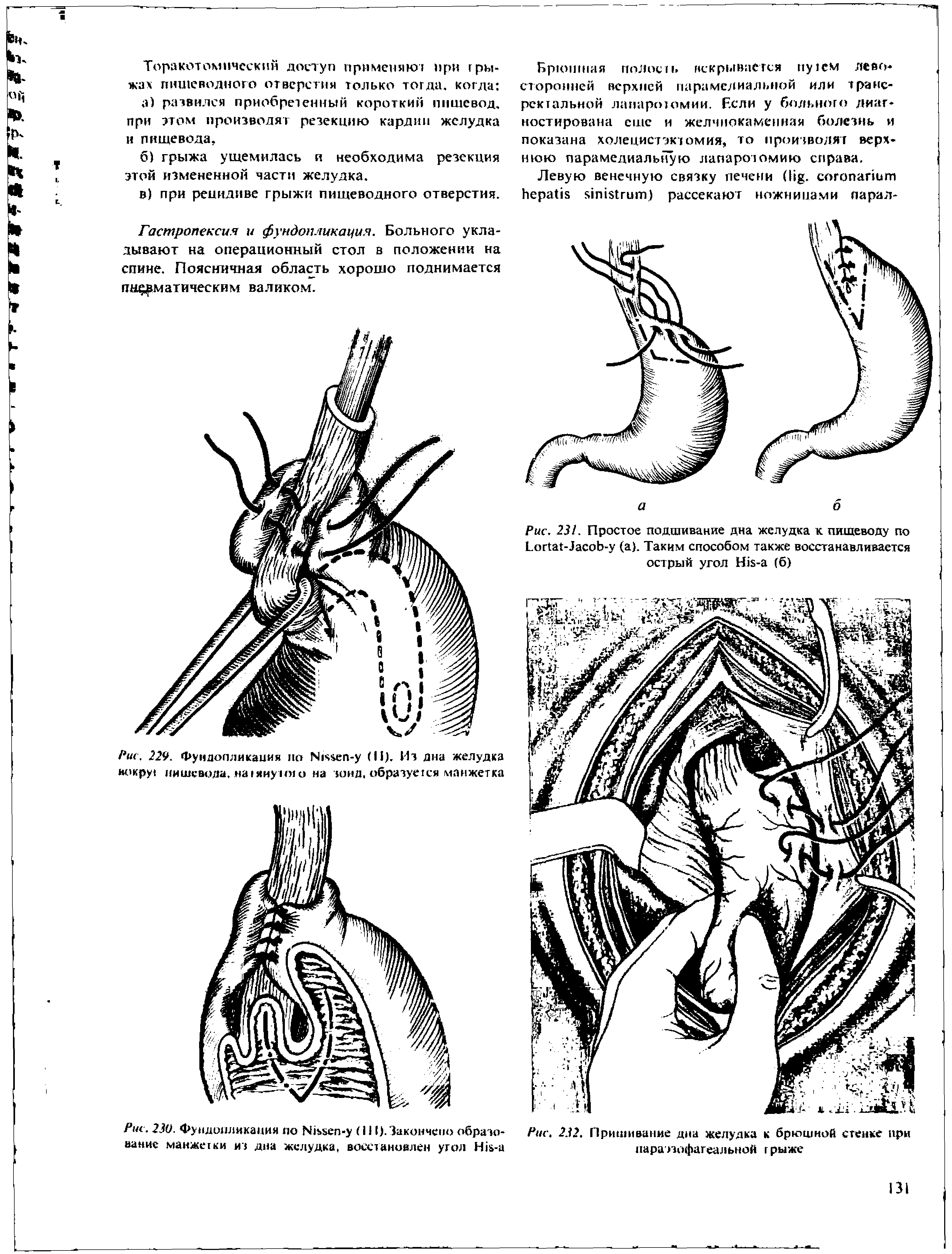 Рис. 230. Фундопликация по N - (IJI). Закончено образование манжетки из дна желудка, восстановлен угол H - ...