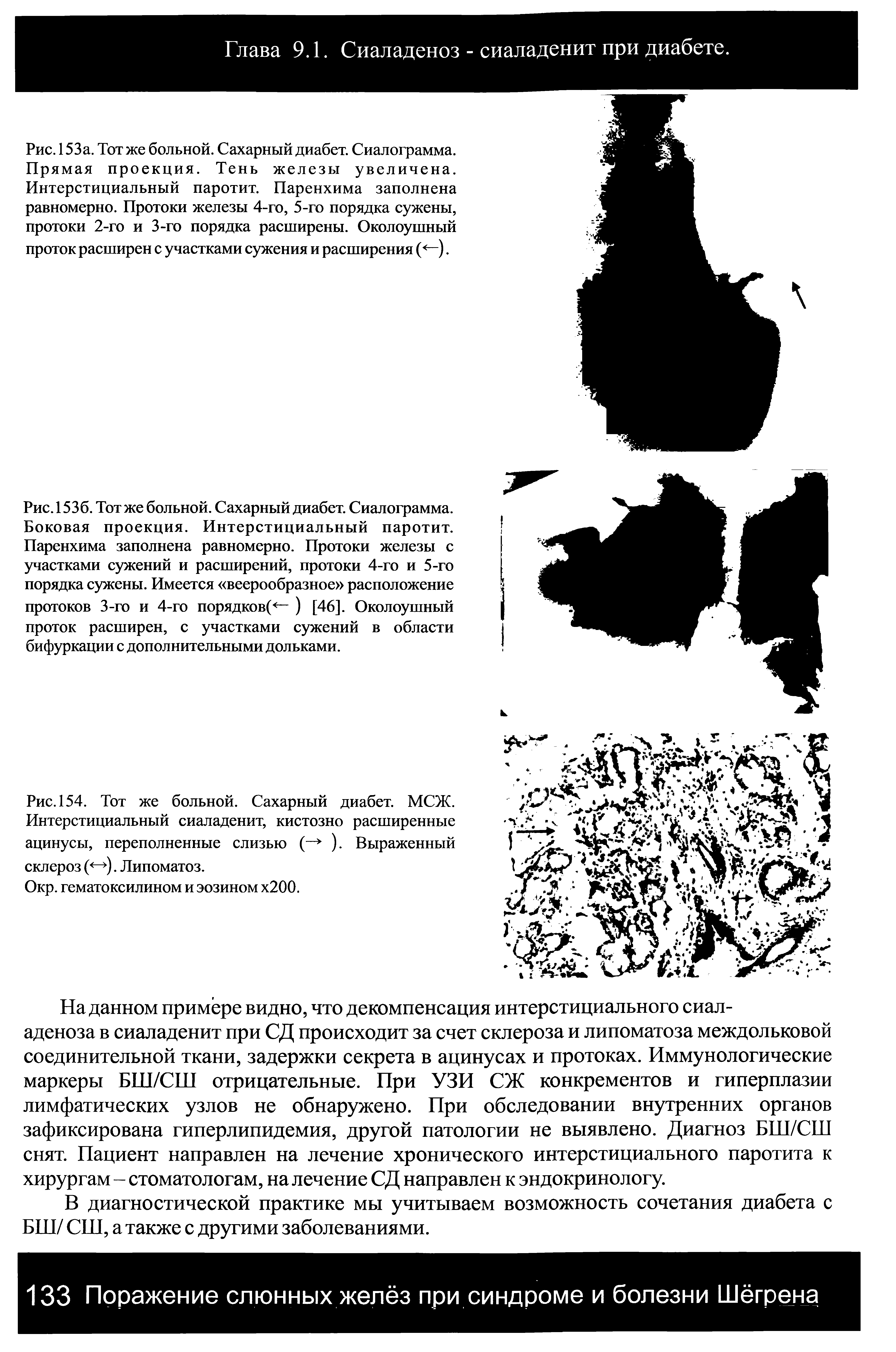 Рис. 153а. Тот же больной. Сахарный диабет. Сиалограмма. Прямая проекция. Тень железы увеличена. Интерстициальный паротит. Паренхима заполнена равномерно. Протоки железы 4-го, 5-го порядка сужены, протоки 2-го и 3-го порядка расширены. Околоушный проток расширен с участками сужения и расширения ( —).