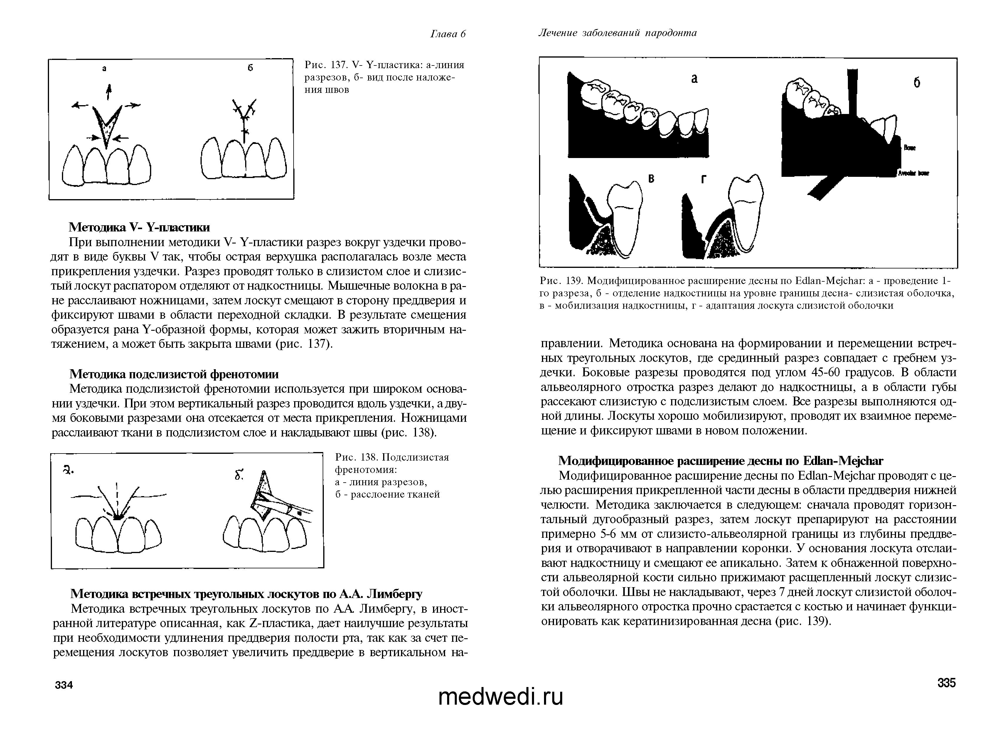 Рис. 139. Модифицированное расширение десны по ЕсИап-Мд сйаг а - проведение 1-го разреза, б - отделение надкостницы на уровне границы десна- слизистая оболочка, в - мобилизация надкостницы, г - адаптация лоскута слизистой оболочки...