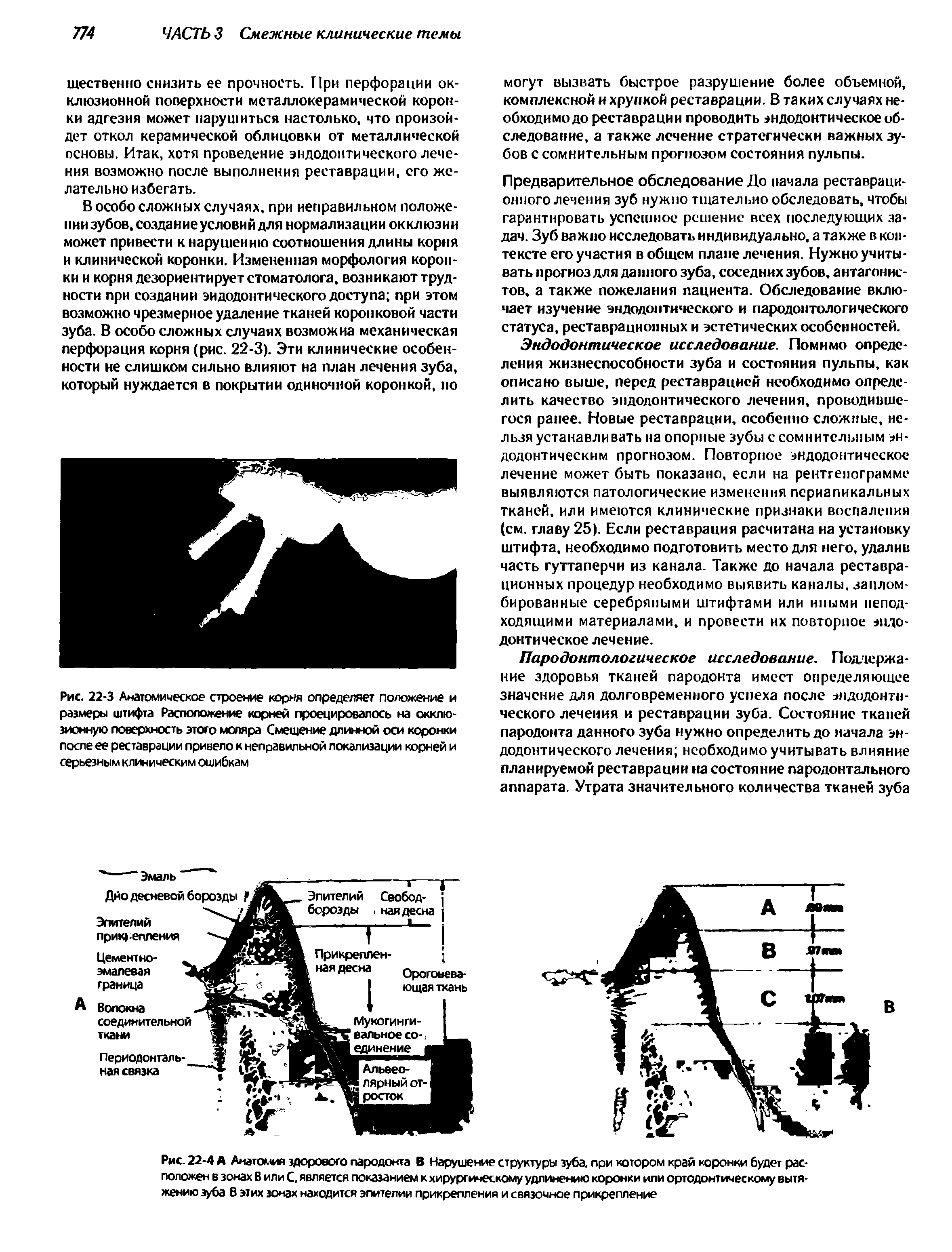 Рис. 22-3 Анатомическое строение корня определяет положение и размеры штифта Расположение корней проецировалось на окклюзионную поверхность этого моляра Смещение длинной оси коронки после ее реставрации привело к неправильной локализации корней и серьезным клиническим ошибкам...