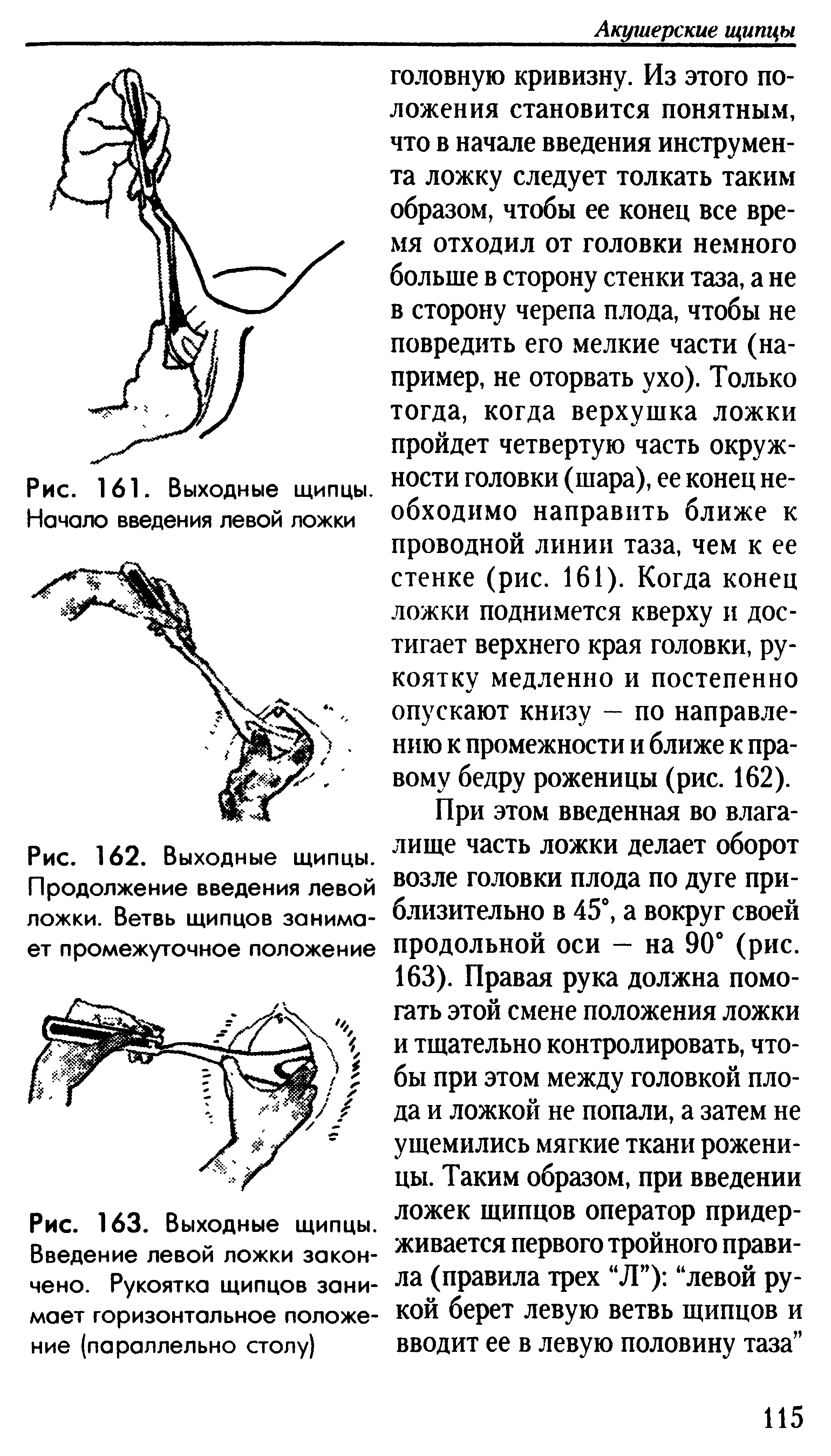 Рис. 162. Выходные щипцы. Продолжение введения левой ложки. Ветвь щипцов занимает промежуточное положение...