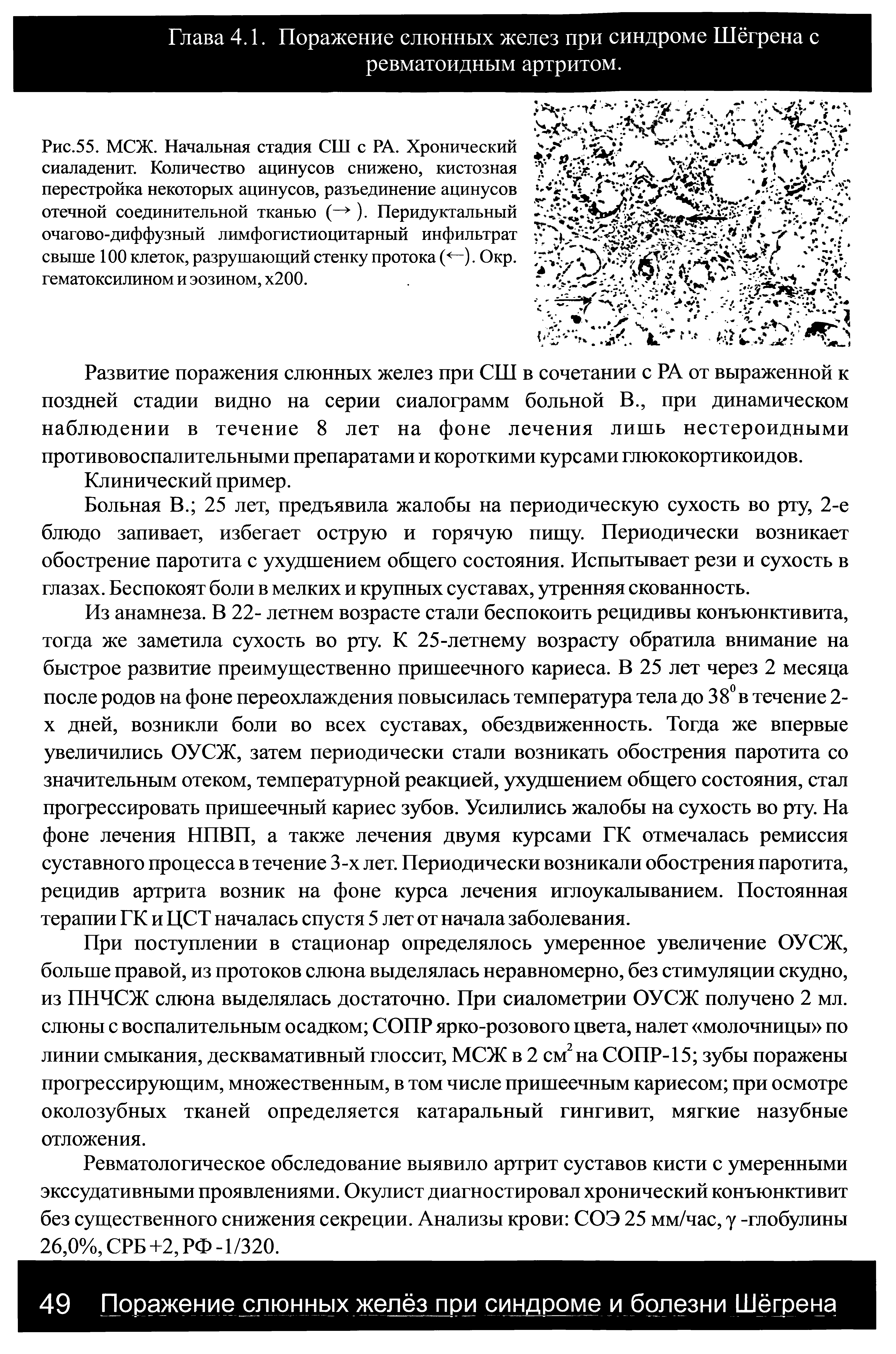 Рис.55. МСЖ. Начальная стадия СШ с РА. Хронический сиаладенит. Количество ацинусов снижено, кистозная перестройка некоторых ацинусов, разъединение ацинусов отечной соединительной тканью (—> ). Перидуктальный очагово-диффузный лимфогистиоцитарный инфильтрат свыше 100 клеток, разрушающий стенку протока ( —). Окр. гематоксилином и эозином, х200.