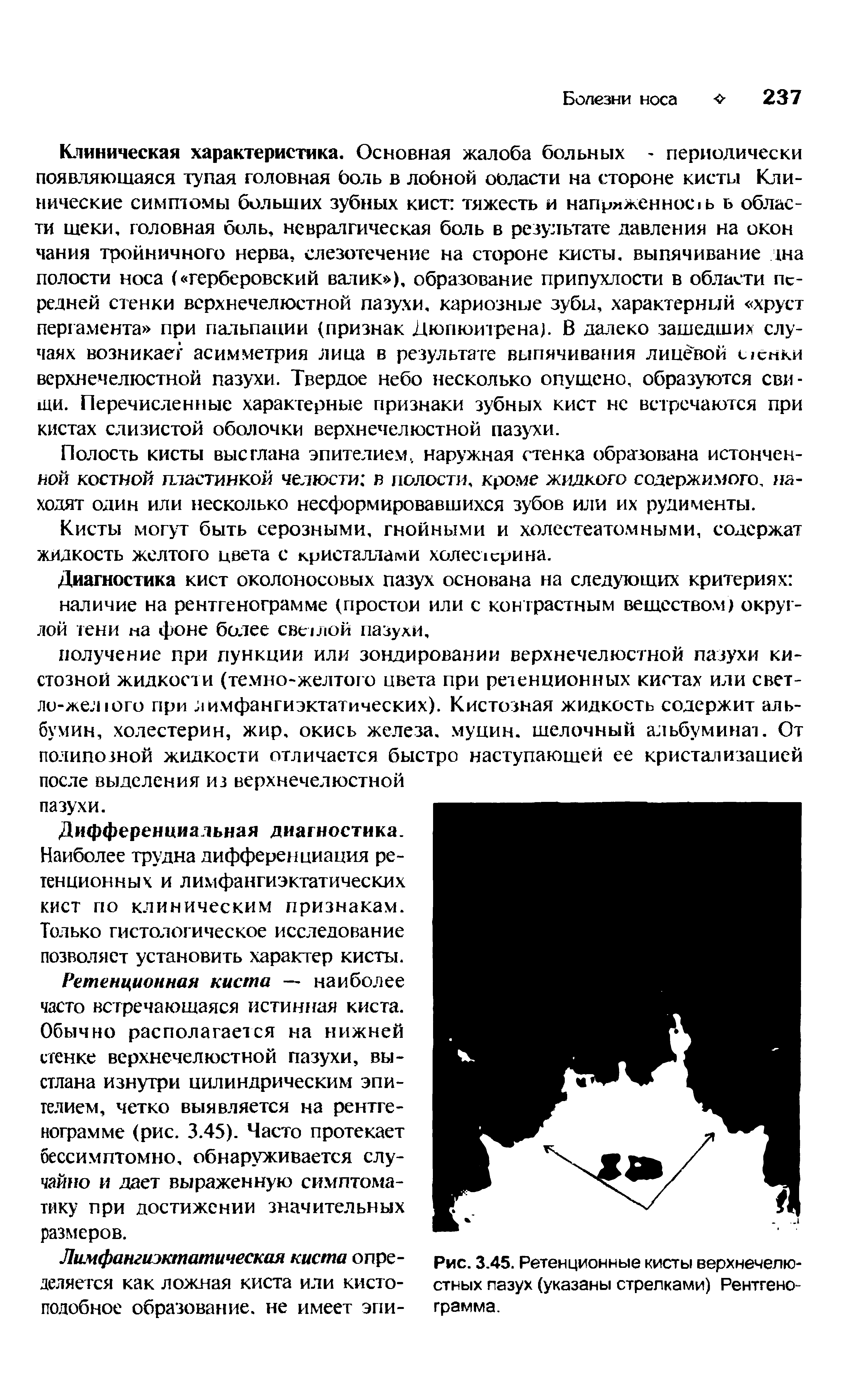 Рис. 3.45. Ретенционные кисты верхнечелюстных пазух (указаны стрелками) Рентгенограмма.