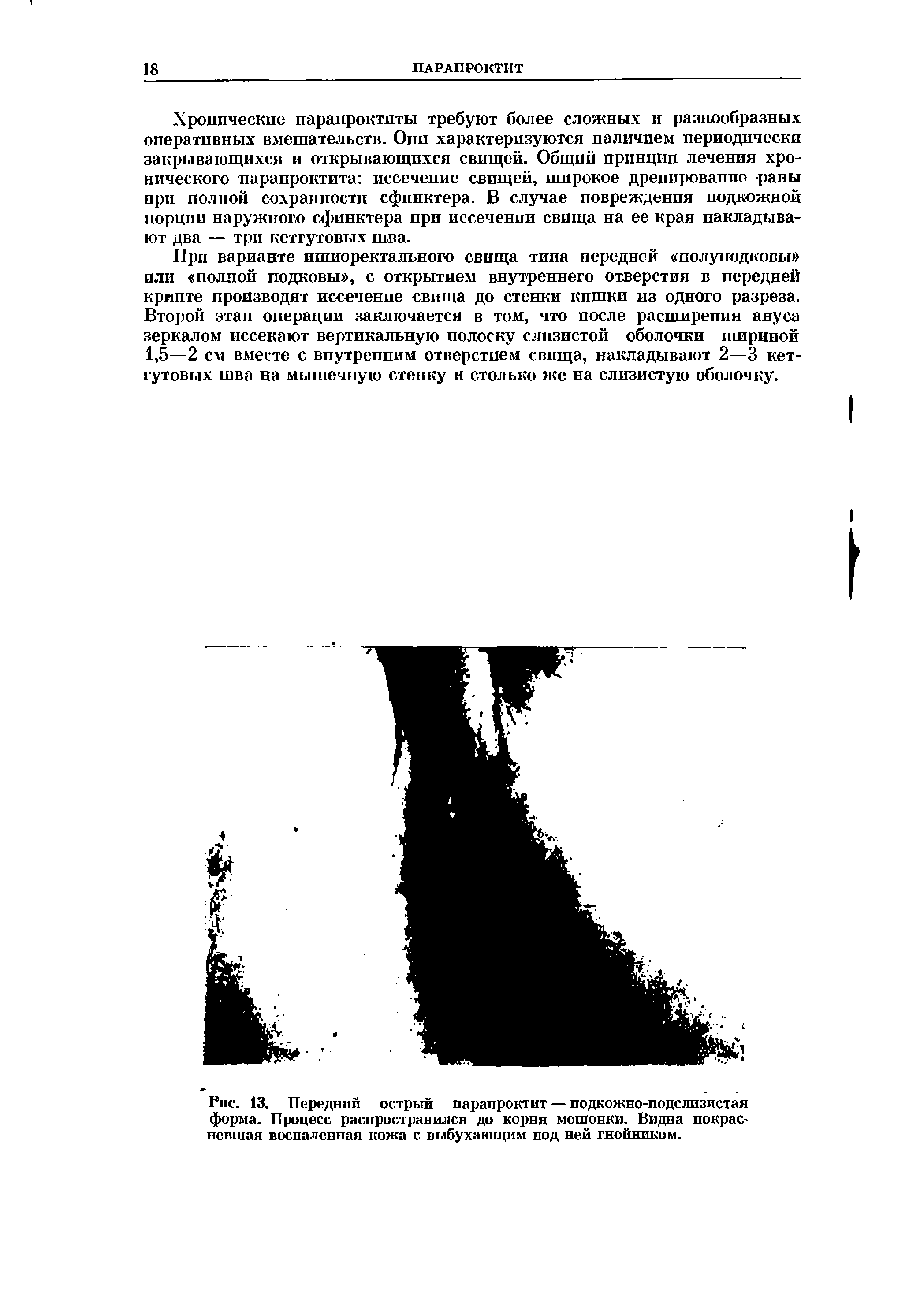 Рис. 13. Передний острый парапроктит — подкожно-подслизистая форма. Процесс распространился до корня мошонки. Видна покрасневшая воспаленная кожа с выбухающим под ней гнойником.