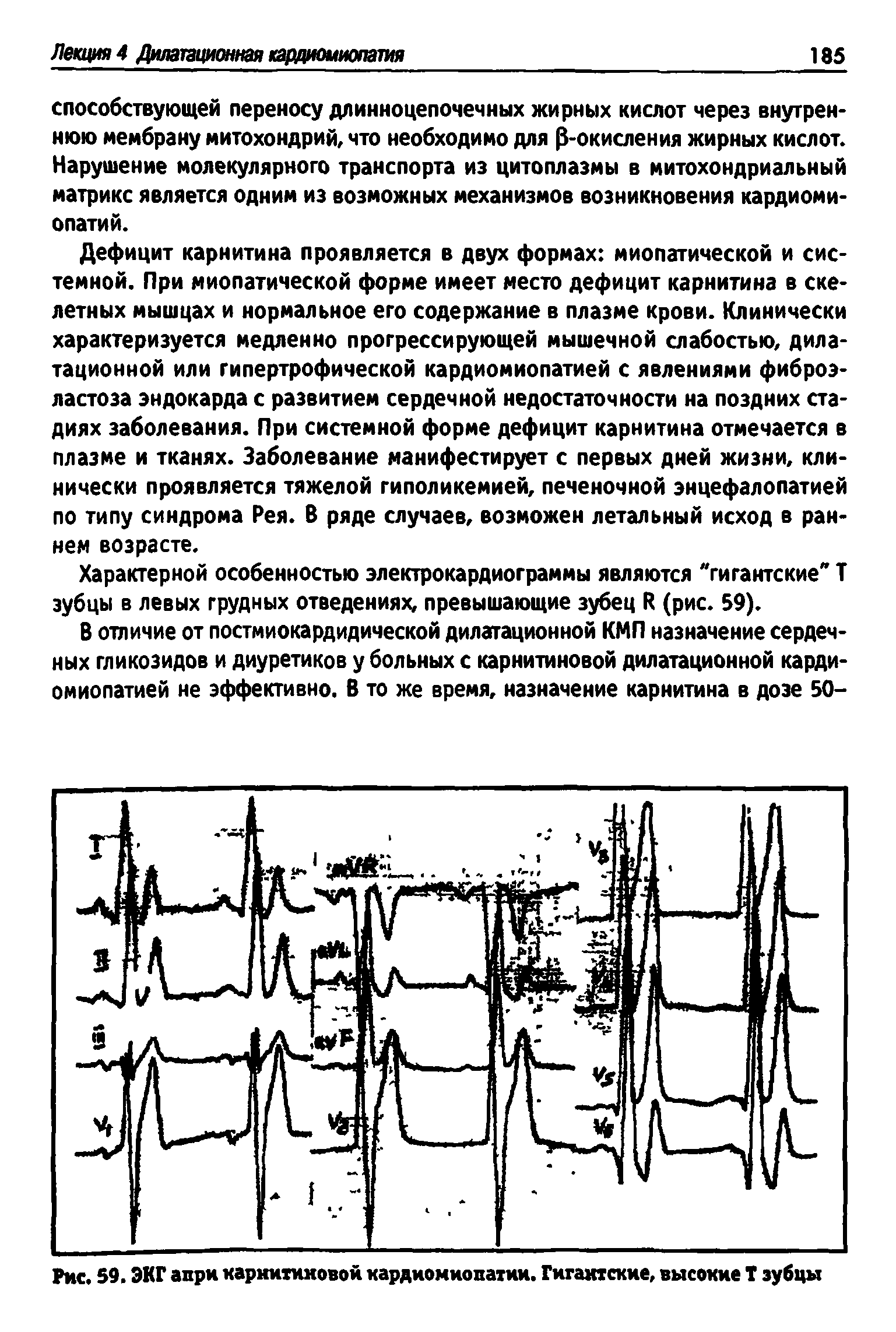 Рис. 59. ЭКГ апри карнитиновой кардиомиопатии. Гигантские, высокие Т зубцы...