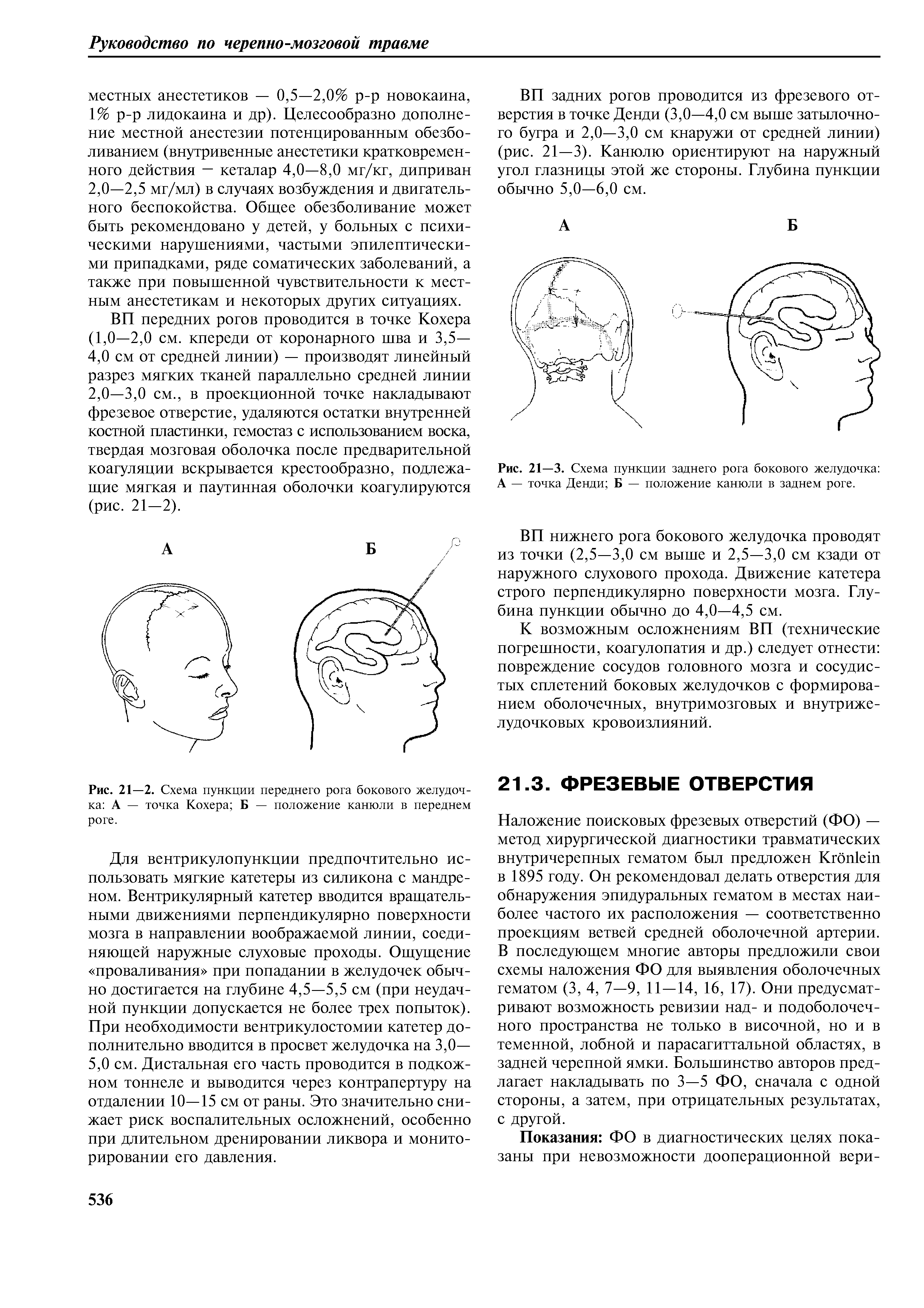 Рис. 21—2. Схема пункции переднего рога бокового желудочка А — точка Кохера Б — положение канюли в переднем роге.