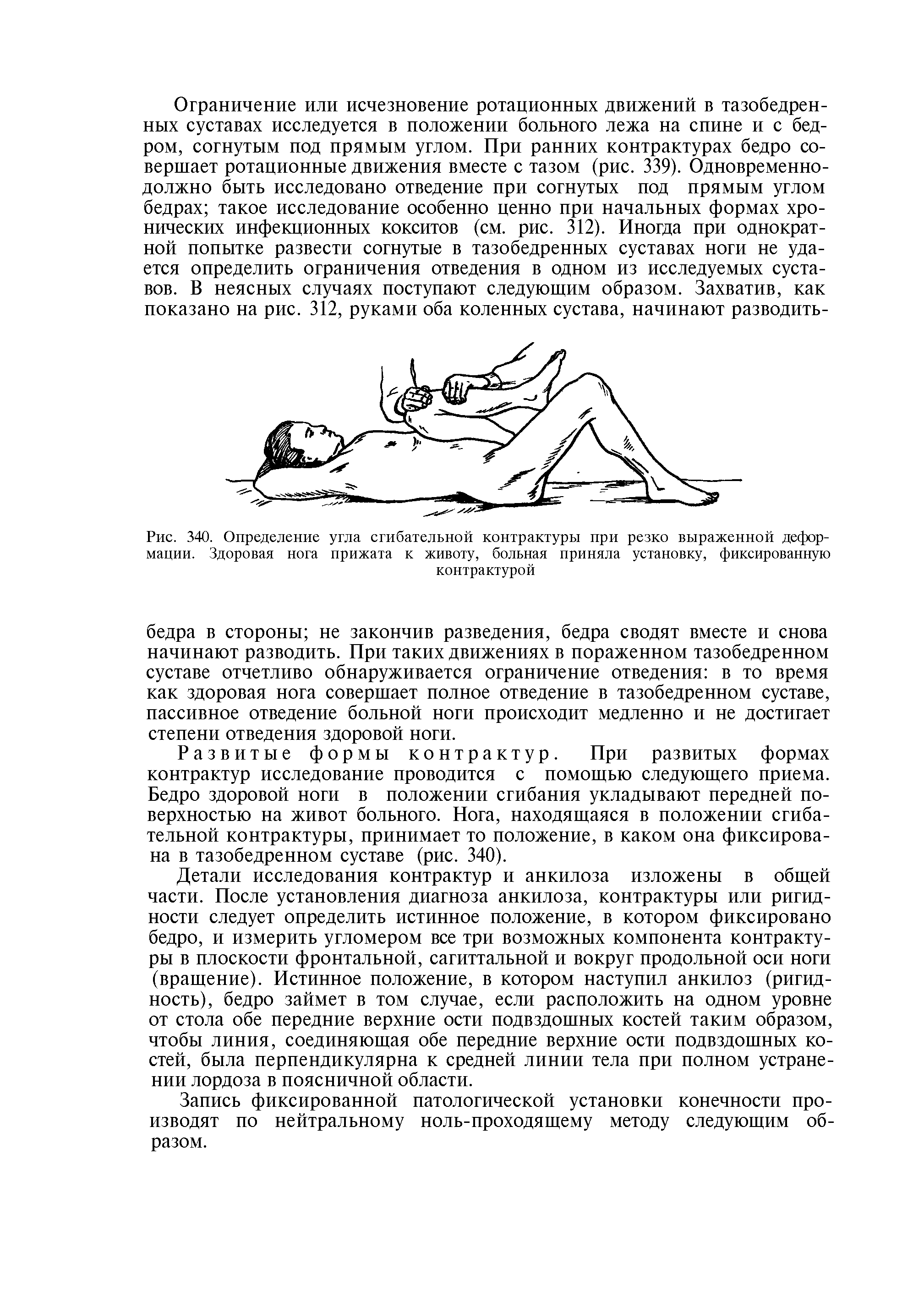 Рис. 340. Определение угла сгибательной контрактуры при резко выраженной деформации. Здоровая нога прижата к животу, больная приняла установку, фиксированную контрактурой...