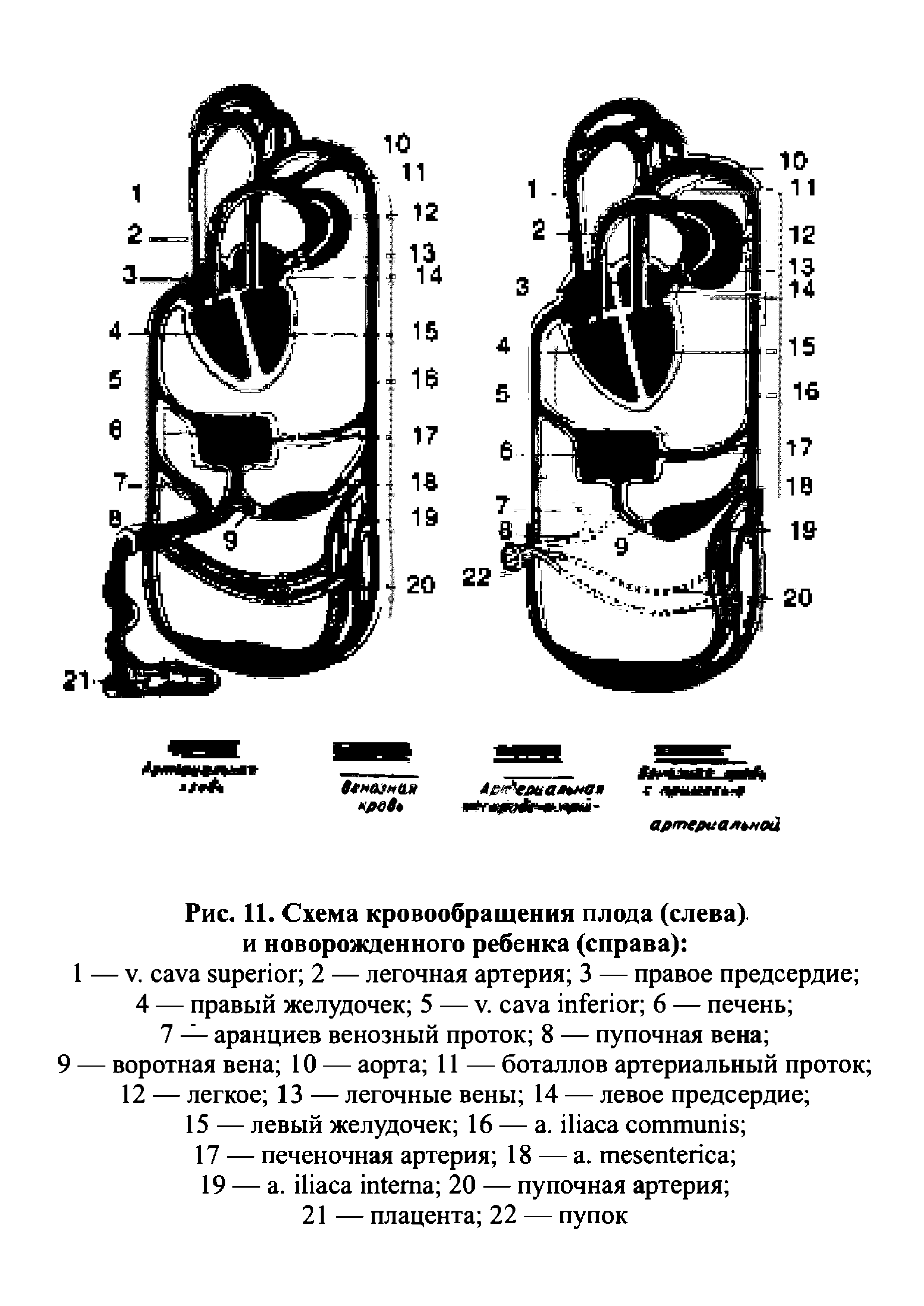 Рис. 11. Схема кровообращения плода (слева) и новорожденного ребенка (справа) ...