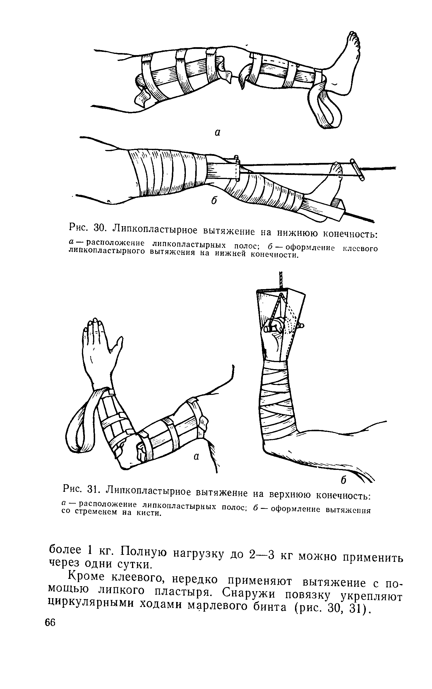 Рис. 30. Липкопластырное вытяжение на нижнюю конечность а — расположение липкопластырных полос б — оформление клеевого липкопластырного вытяжения на иижней конечности.