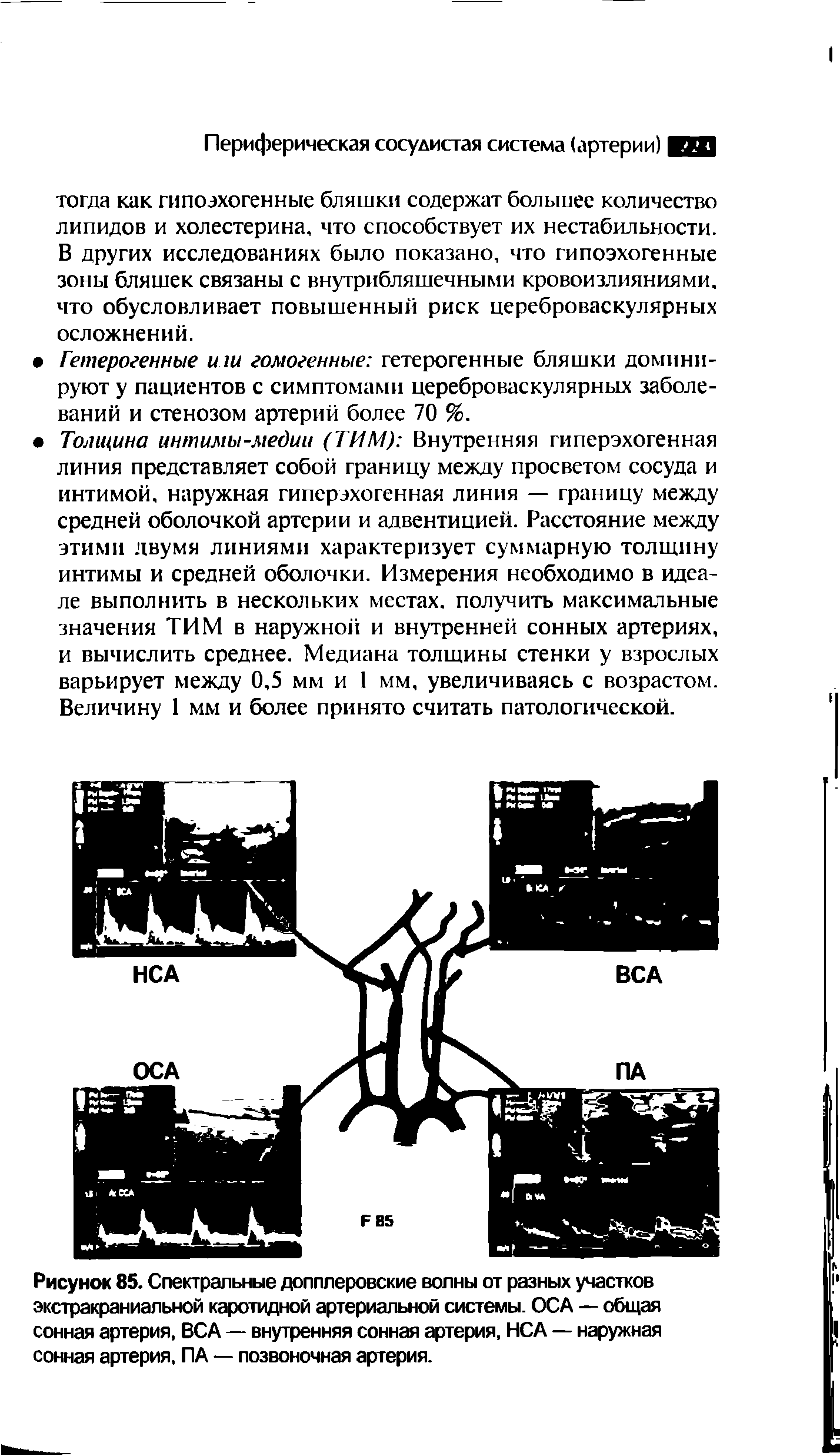 Рисунок 85. Спектральные допплеровские волны от разных участков экстракраниальной каротидной артериальной системы. ОСА — общая сонная артерия, ВСА — внутренняя сонная артерия, НСА — наружная сонная артерия, ПА — позвоночная артерия.