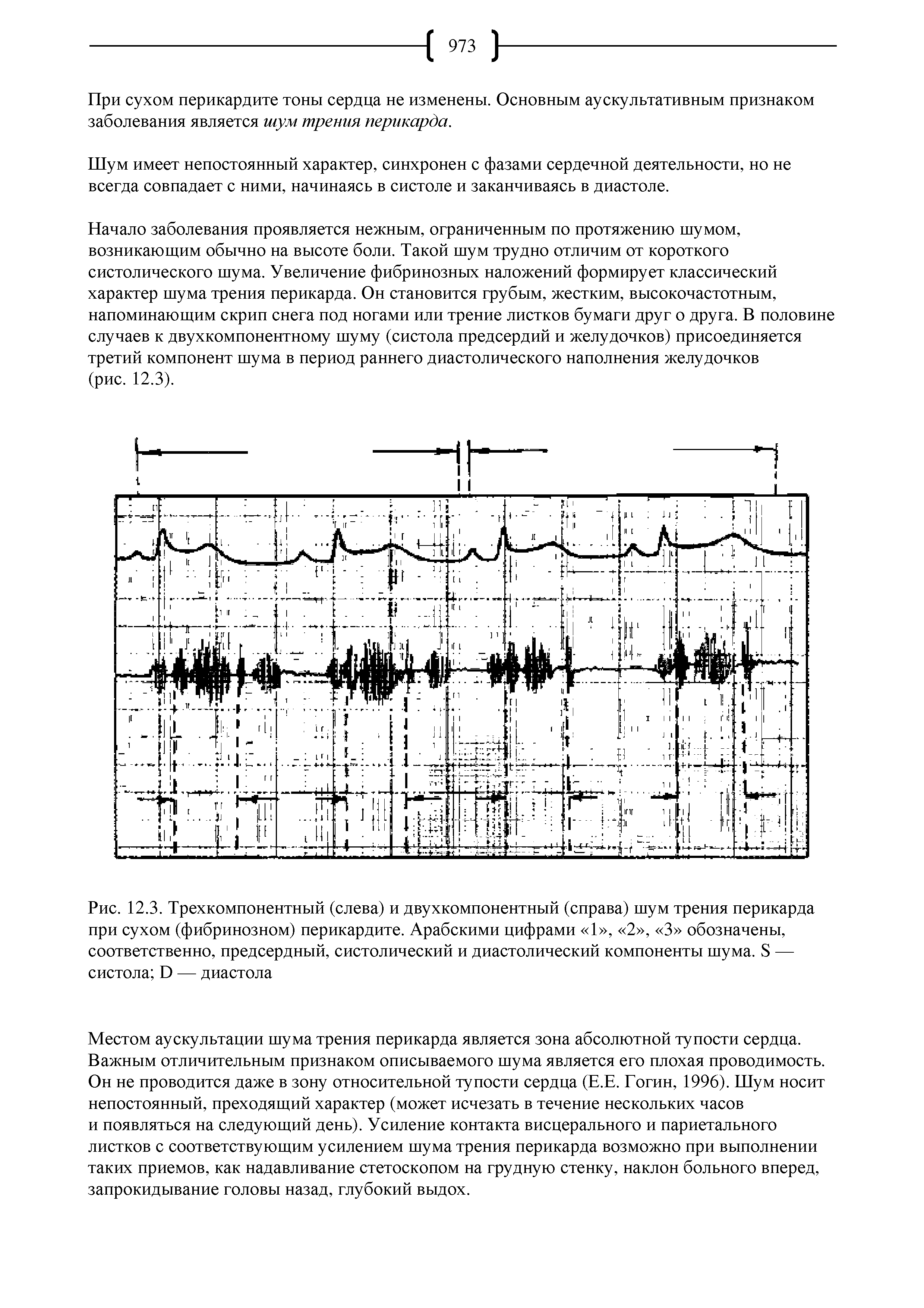 Рис. 12.3. Трехкомпонентный (слева) и двухкомпонентный (справа) шум трения перикарда при сухом (фибринозном) перикардите. Арабскими цифрами 1 , 2 , 3 обозначены, соответственно, предсердный, систолический и диастолический компоненты шума. 8 — систола Э — диастола...