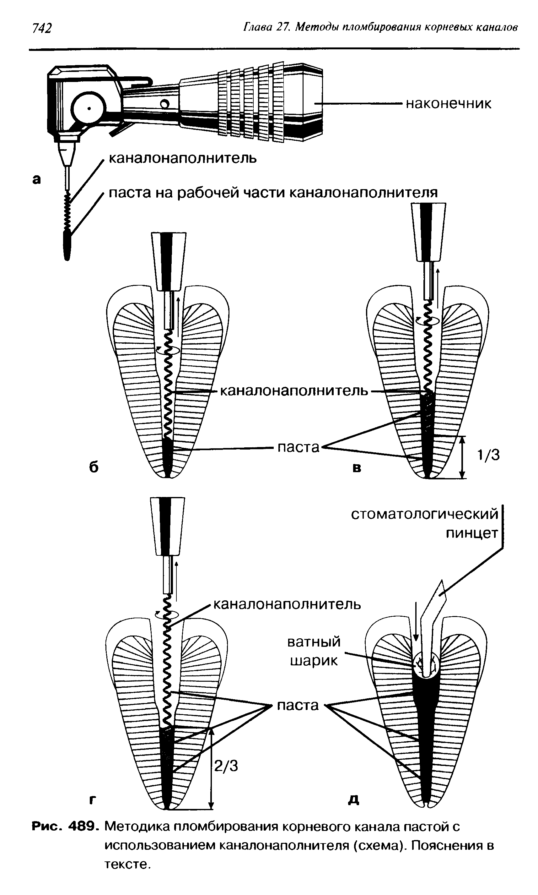 Рис. 489. Методика пломбирования корневого канала пастой с использованием каналонаполнителя (схема). Пояснения в...