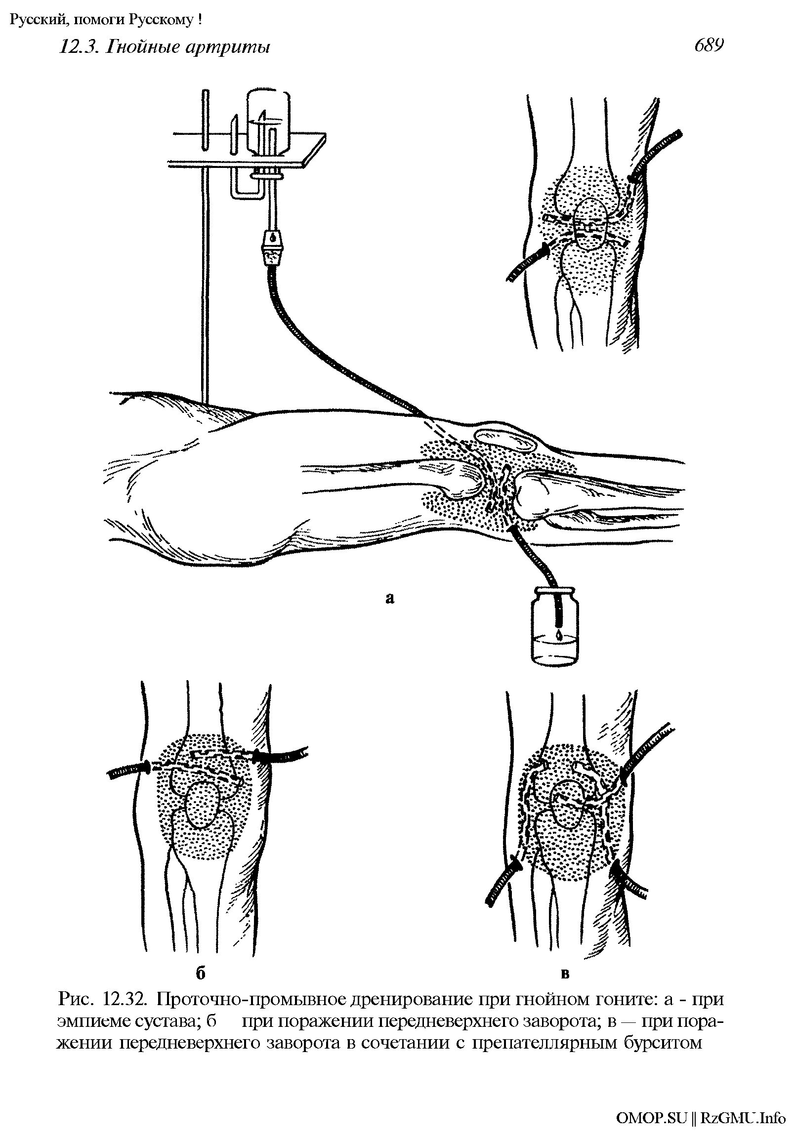 Рис. 12.32. Проточно-промывное дренирование при гнойном гоните а - при эмпиеме сустава б при поражении передневерхнего заворота в — при поражении передневерхнего заворота в сочетании с препателлярным бурситом...