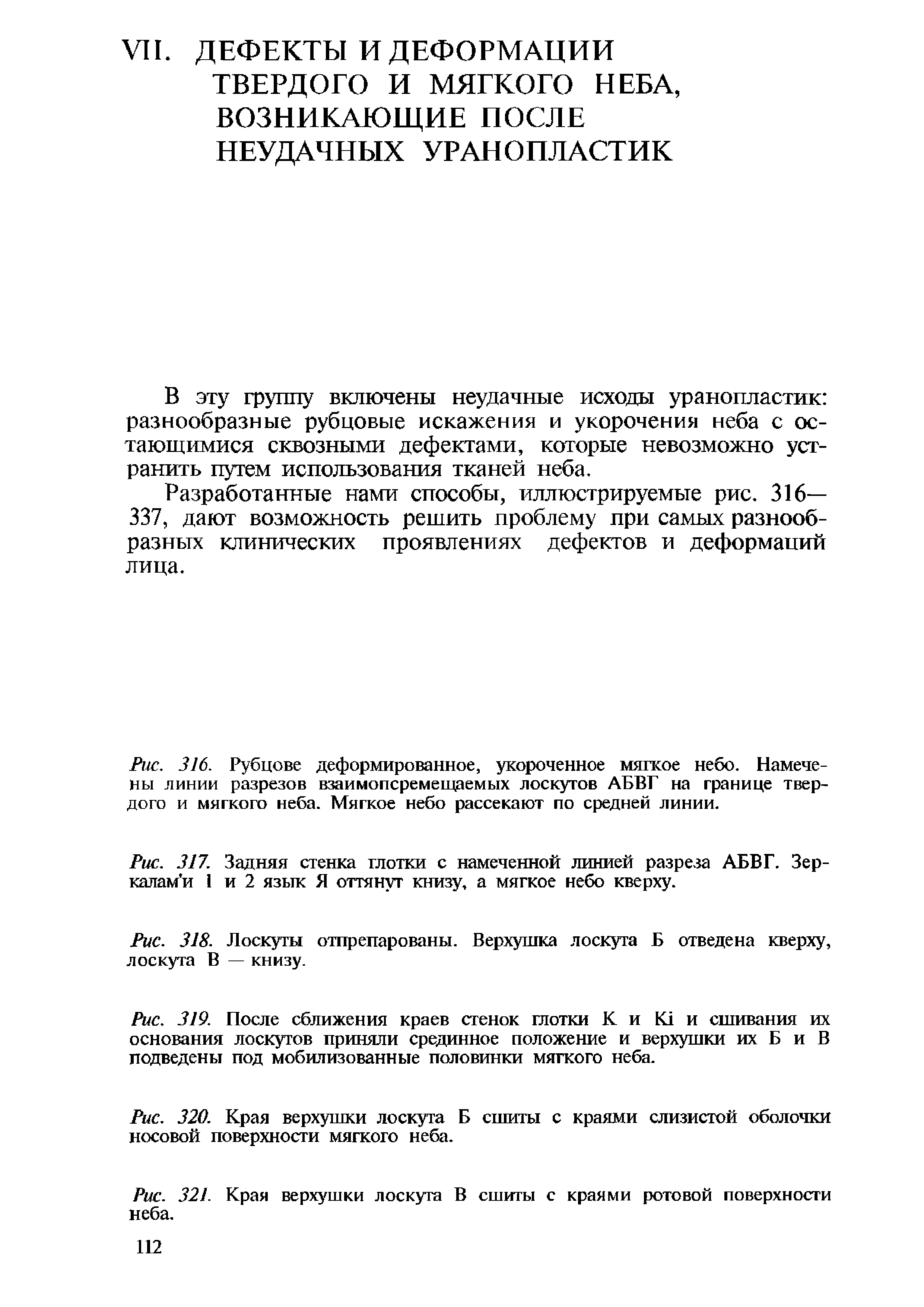 Рис. 316. Рубцове деформированное, укороченное мягкое небо. Намечены линии разрезов взаимопсремещаемых лоскутов АБВГ на границе твердого и мягкого неба. Мягкое небо рассекают по средней линии.