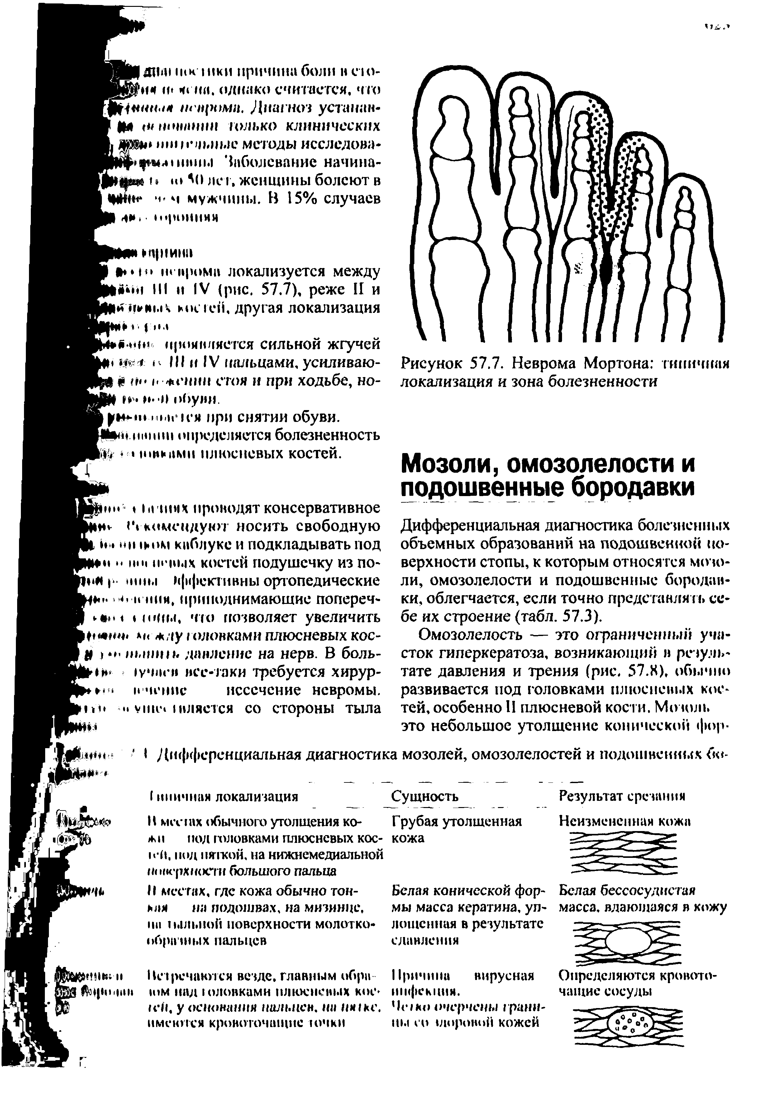 Рисунок 57.7. Неврома Мортона типичная локализация и зона болезненности...