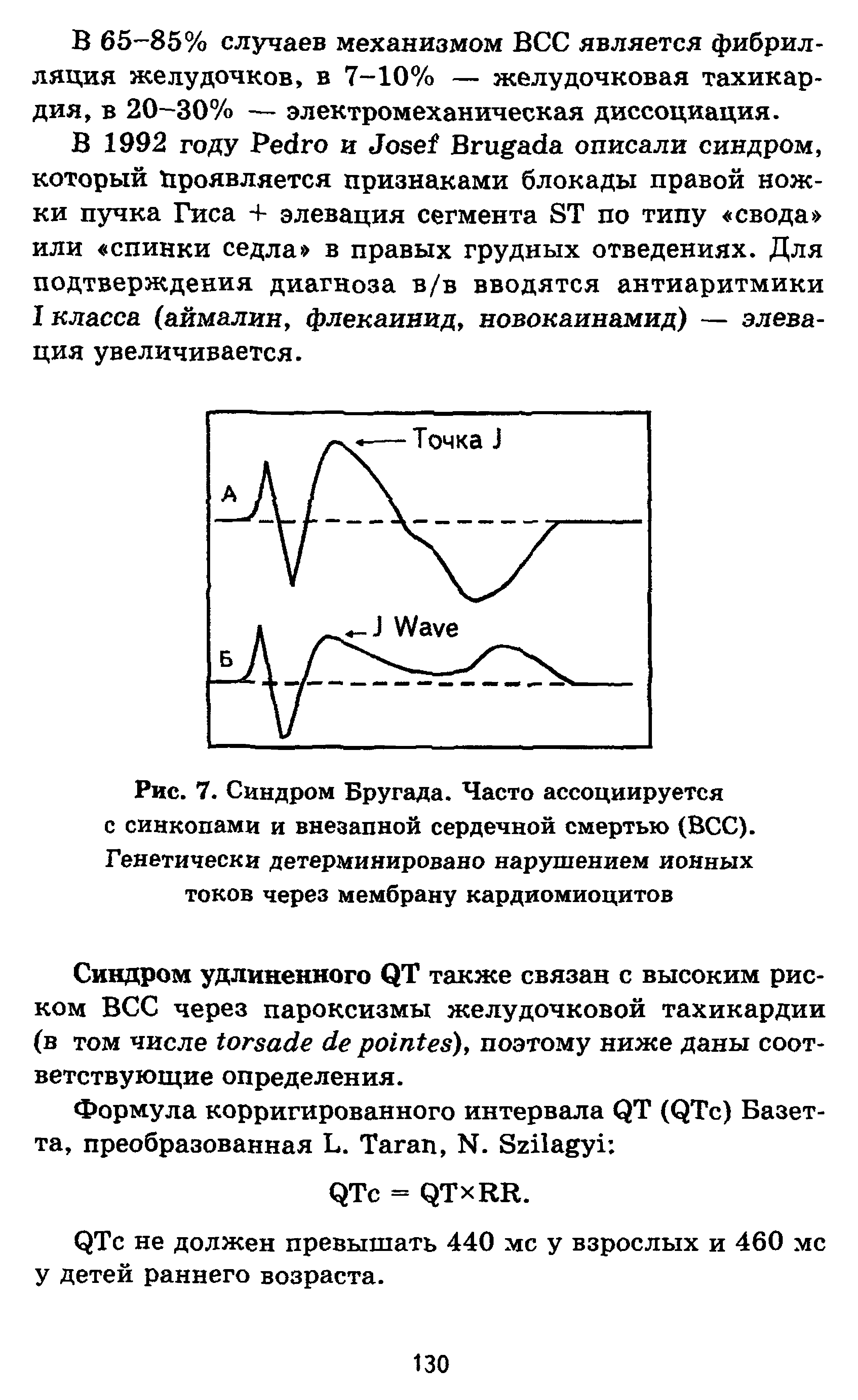 Рис. 7. Синдром Бругада. Часто ассоциируется с синкопами и внезапной сердечной смертью (ВСС). Генетически детерминировано нарушением ионных токов через мембрану кардиомиоцитов...