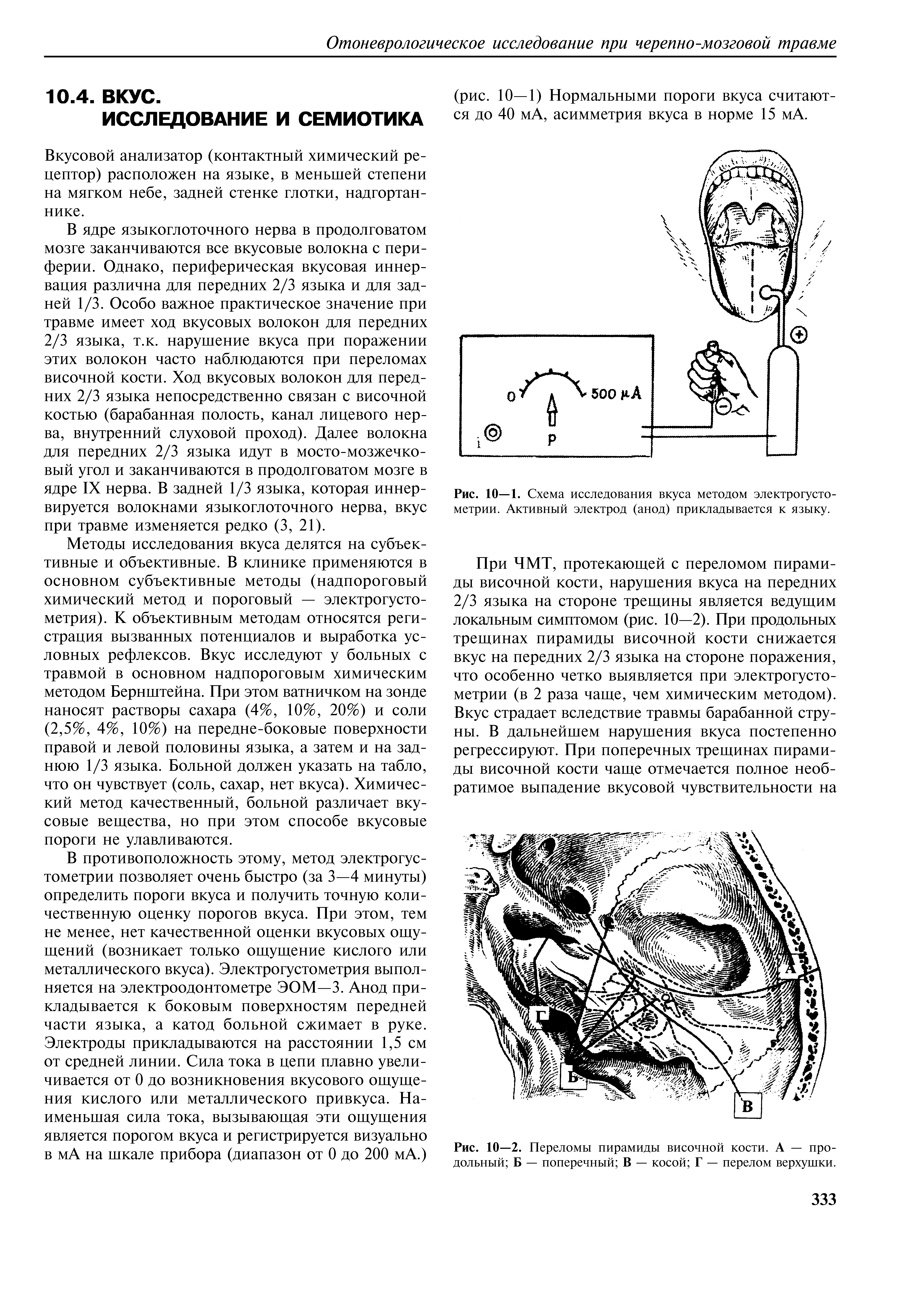 Рис. 10—2. Переломы пирамиды височной кости. А — продольный Б — поперечный В — косой Г — перелом верхушки.