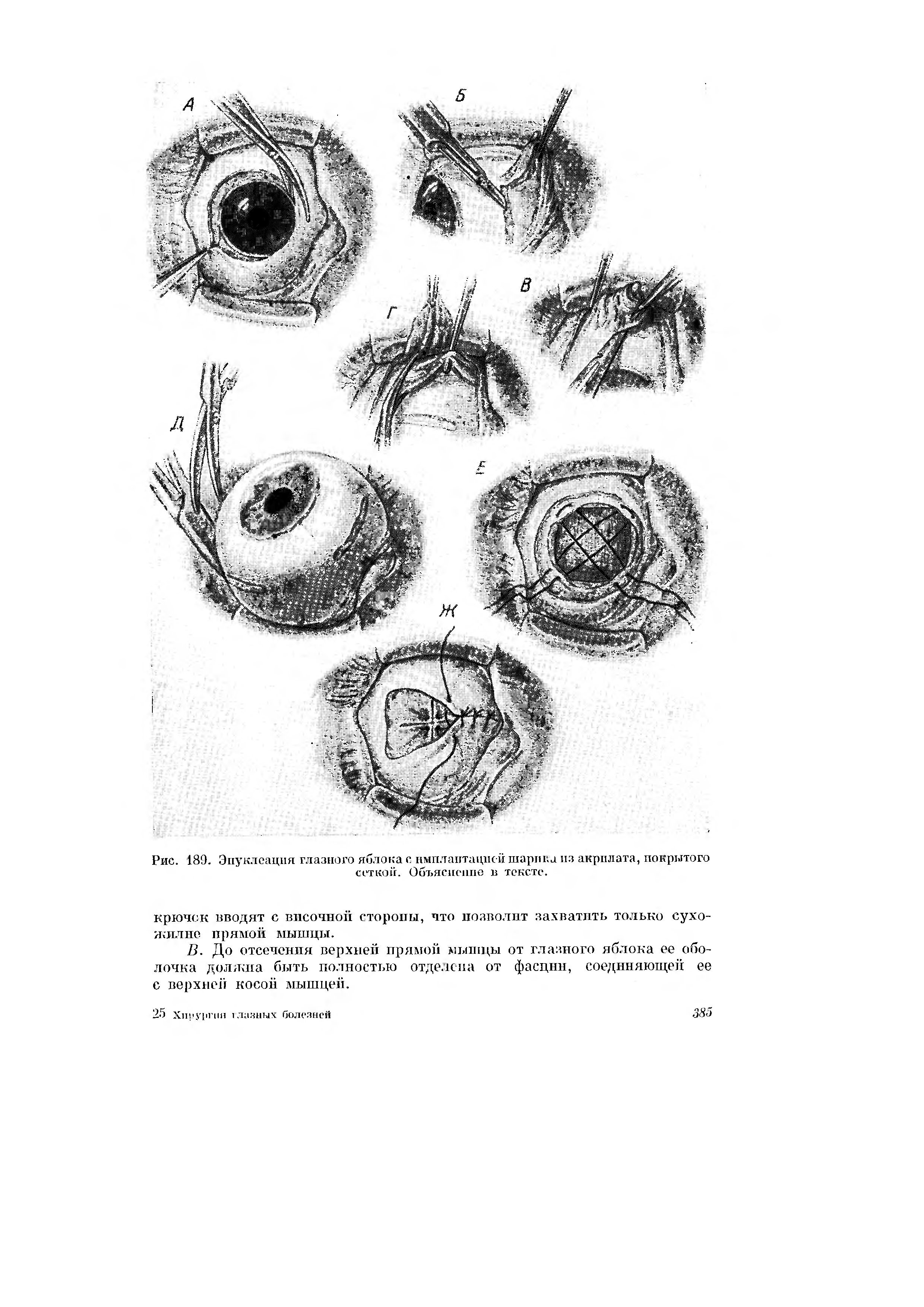 Рис. 189. Энуклеация глазного яблока с имплантацие й шарика из акрилата, покрытого сеткой. Объяснение и тексте.