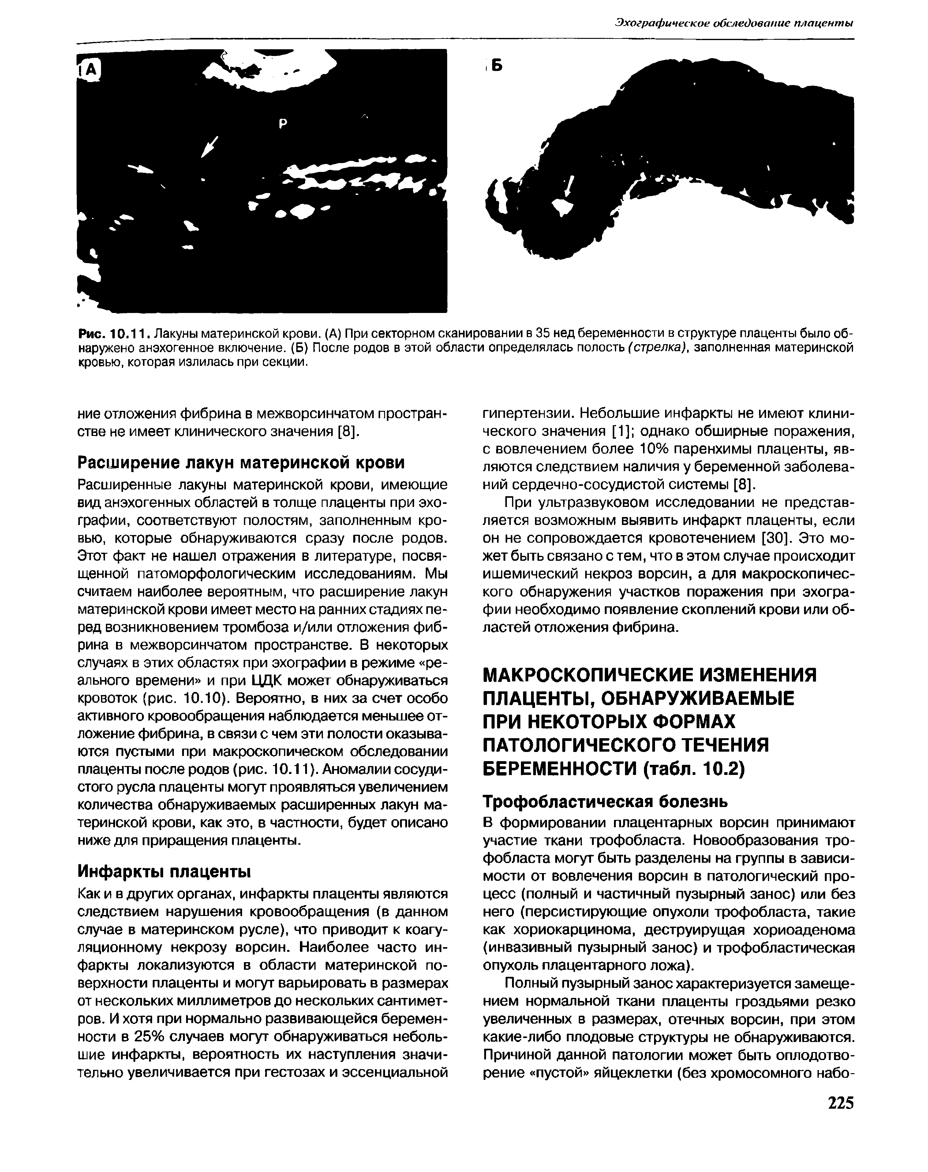 Рис. 10.11. Лакуны материнской крови. (А) При секторном сканировании в 35 нед беременности в структуре плаценты было обнаружено анэхогенное включение. (Б) После родов в этой области определялась полость (стрелка), заполненная материнской кровью, которая излилась при секции.