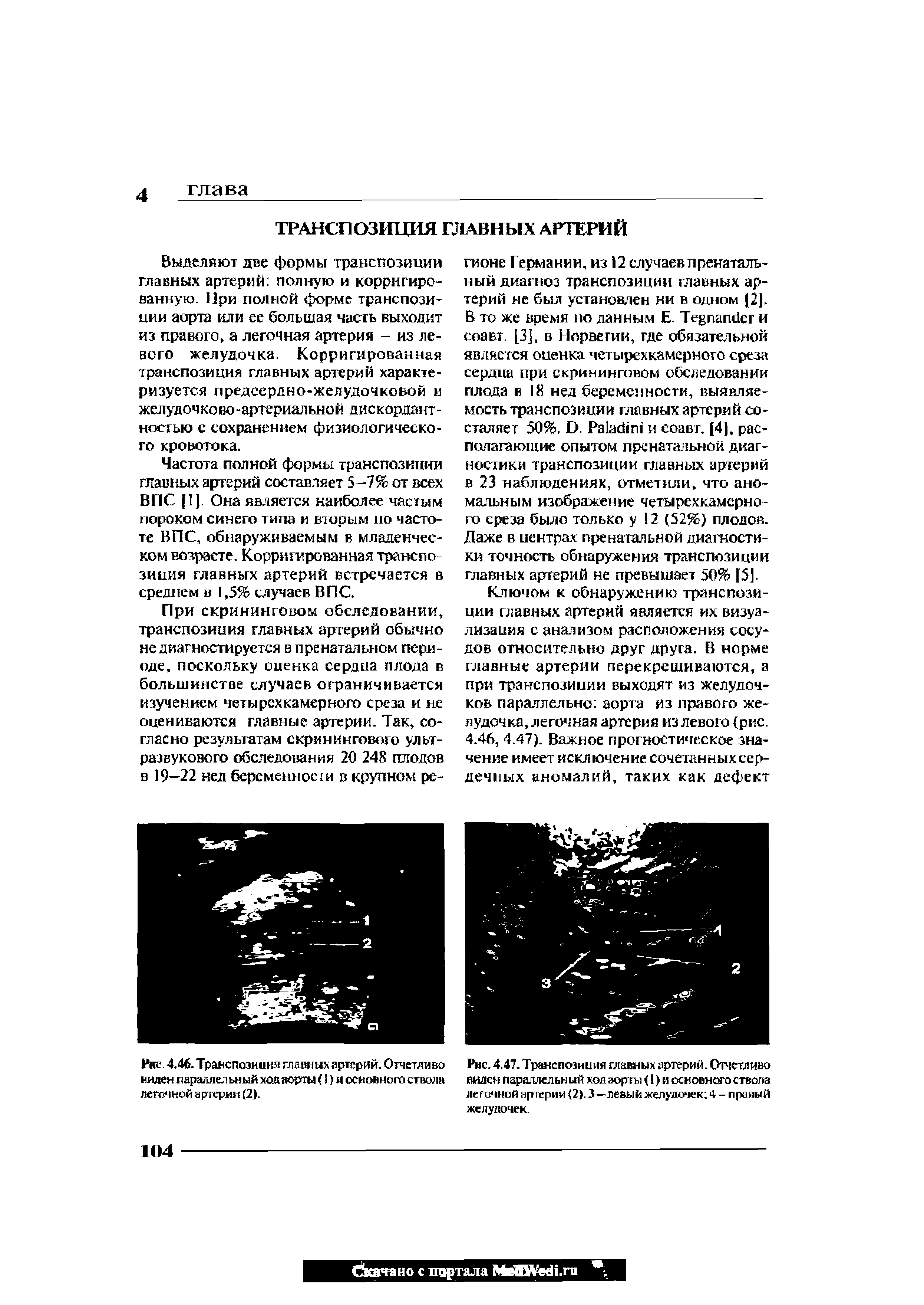 Рис. 4.46. Транспозиция главных артерий. Отчетливо Рис. 4.47. Транспозиция главных артерий. Отчетливо пилен параллельный ход аорты ( ) и основного ствола виден параллельный ход аорты (1) и основного ствола легочной артерии (2). легочной артерии (2). 3—левый желудочек 4-правый...