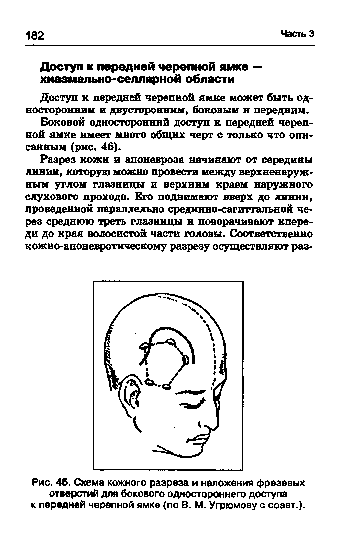 Рис. 46. Схема кожного разреза и наложения фрезевых отверстий для бокового одностороннего доступа к передней черепной ямке (по В. М. Угрюмову с соавт.).