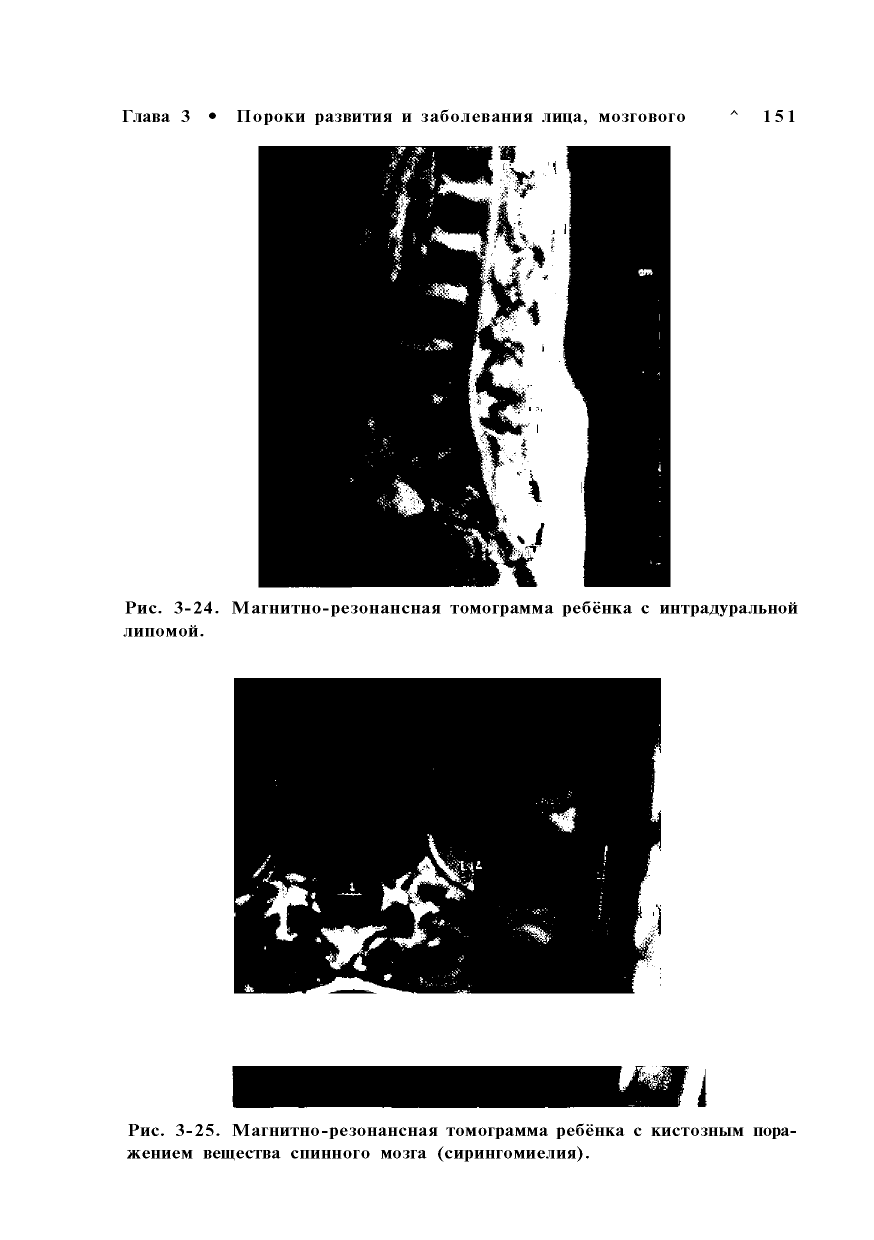Рис. 3-24. Магнитно-резонансная томограмма ребёнка с интрадуральной липомой.