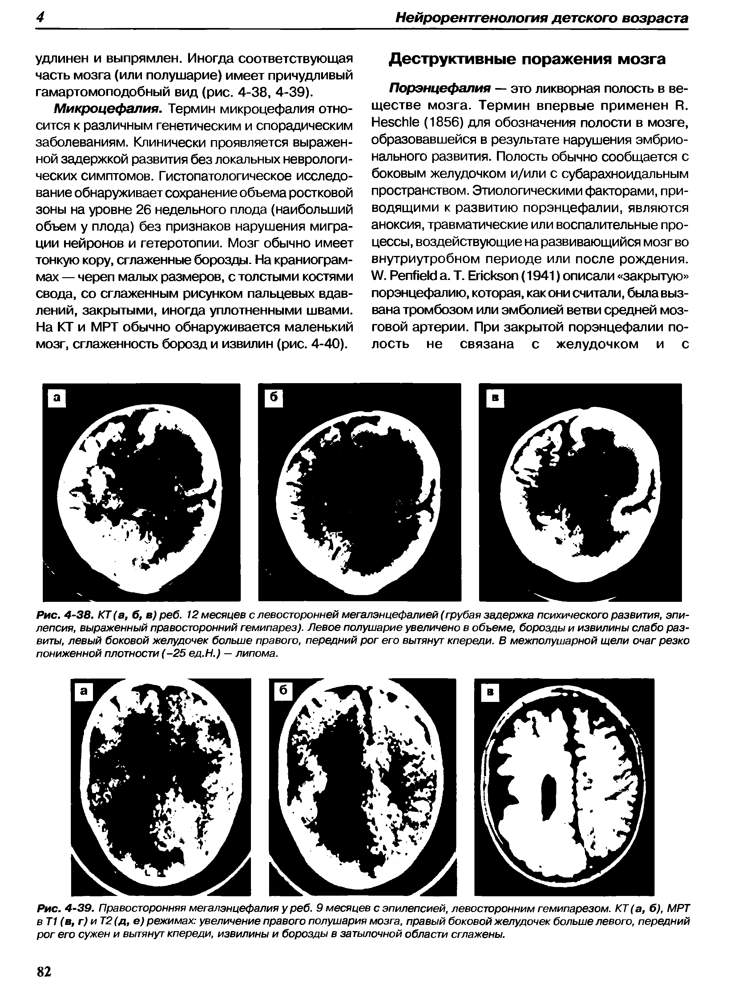 Рис. 4-38. КТ (а, б, в) реб. 12 месяцев с левосторонней мегалэнцефалией (грубая задержка психического развития, эпилепсия, выраженный правосторонний гемипарез). Левое полушарие увеличено в объеме, борозды и извилины слабо развиты, левый боковой желудочек больше правого, передний рог его вытянут кпереди. В межполушарной щели очаг резко пониженной плотности (-25 ед.Н.) — липома.