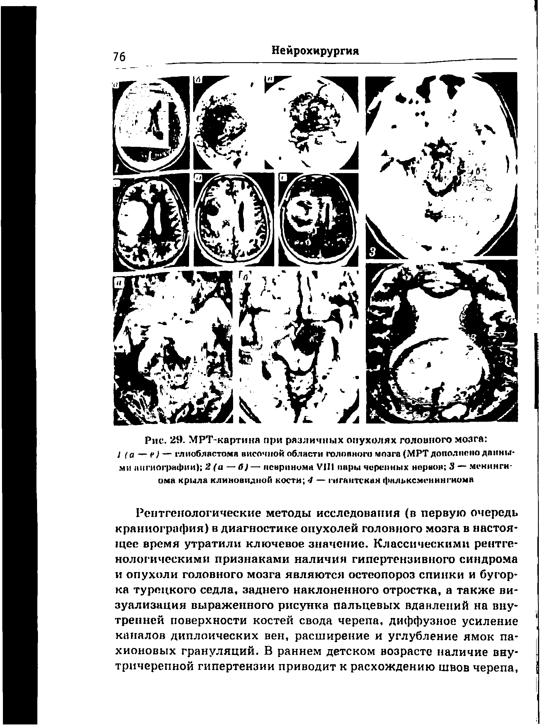 Рис. 29. МРТ-картиня при различных опухолях головного мозга J (а — г — глиобластома височной области головного мозга (МРТ дополнено данными ангиографии) 2 (а — б) — невринома VIH пиры черепных нервов 3 — менингиома крыла клиновидной кости -1 — гигантская фальксменннгиома...