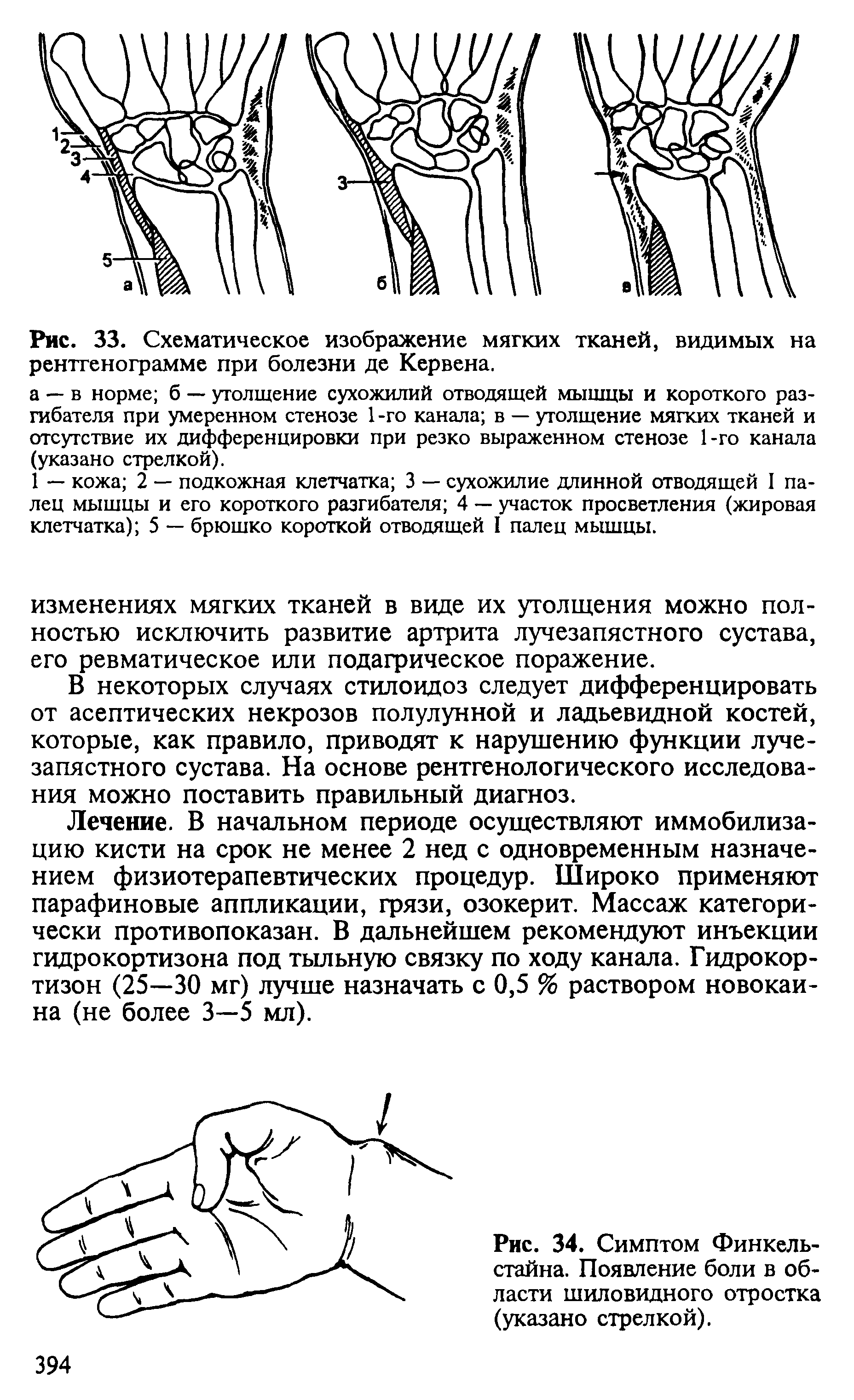 Рис. 33. Схематическое изображение мягких тканей, видимых на рентгенограмме при болезни де Кервена.