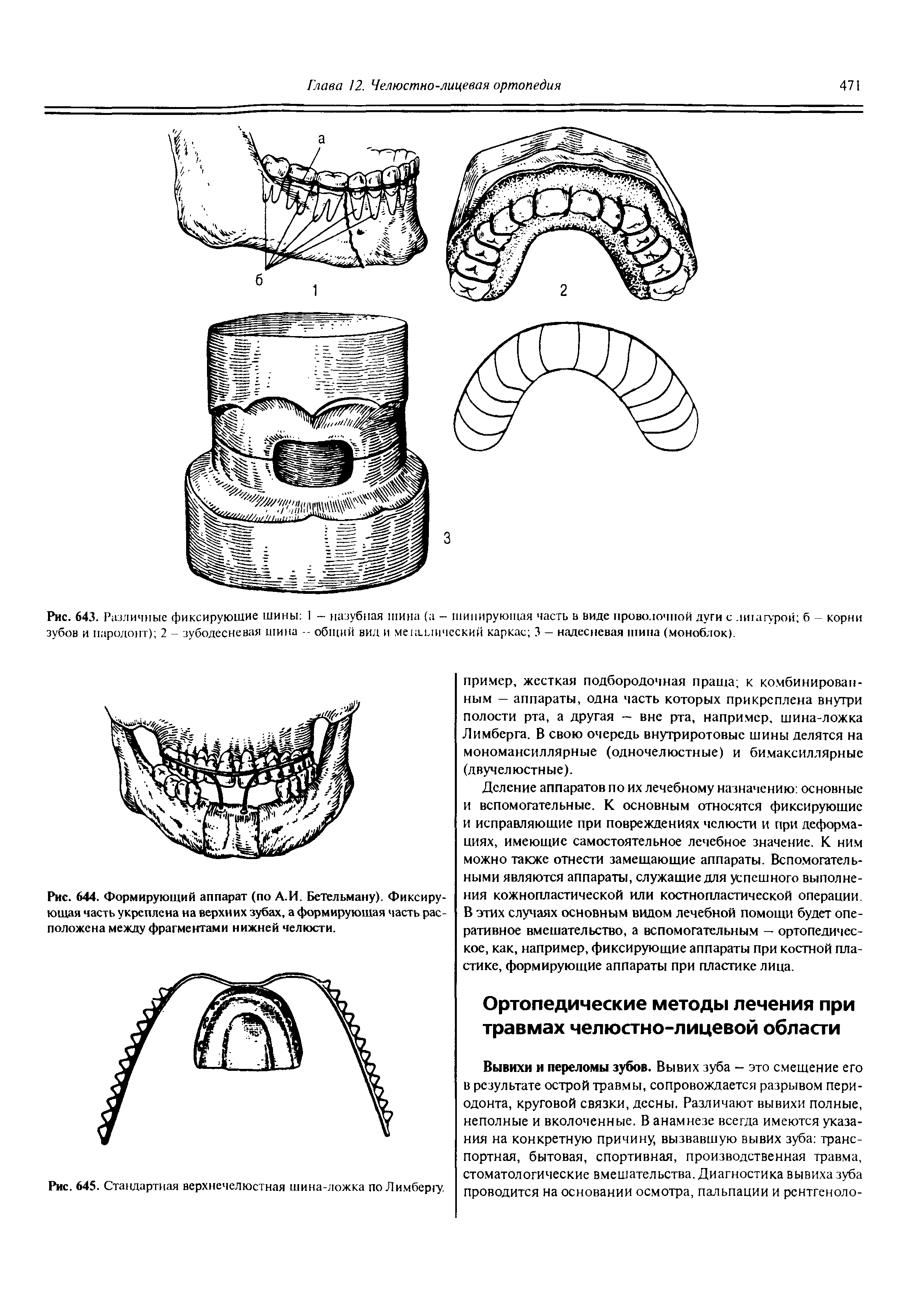 Рис. 644. Формирующий аппарат (по А.И. Бетельману). Фиксирующая часть укреплена на верхних зубах, а формирующая часть расположена между фрагментами нижней челюсти.