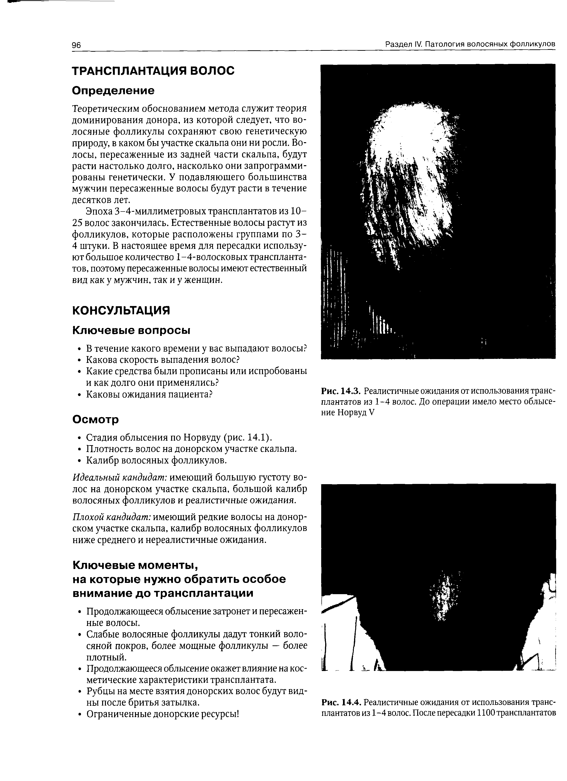 Рис. 14.3. Реалистичные ожидания от использования трансплантатов из 1-4 волос. До операции имело место облысение Норвуд V...