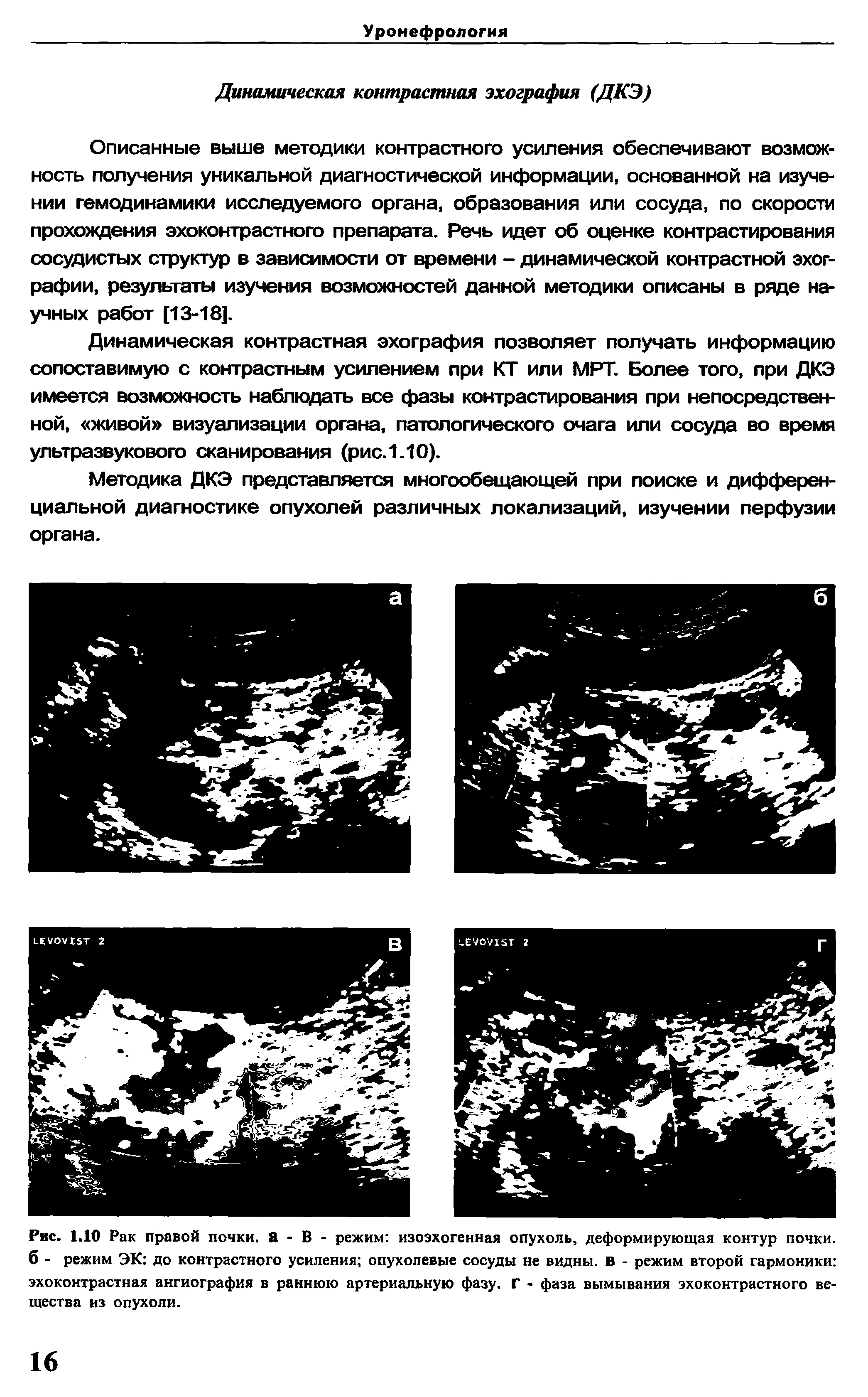 Рис. 1.10 Рак правой почки, а - В - режим изоэхогенная опухоль, деформирующая контур почки, б - режим ЭК до контрастного усиления опухолевые сосуды не видны, в - режим второй гармоники эхоконтрастная ангиография в раннюю артериальную фазу. Г - фаза вымывания эхоконтрастного вещества из опухоли.