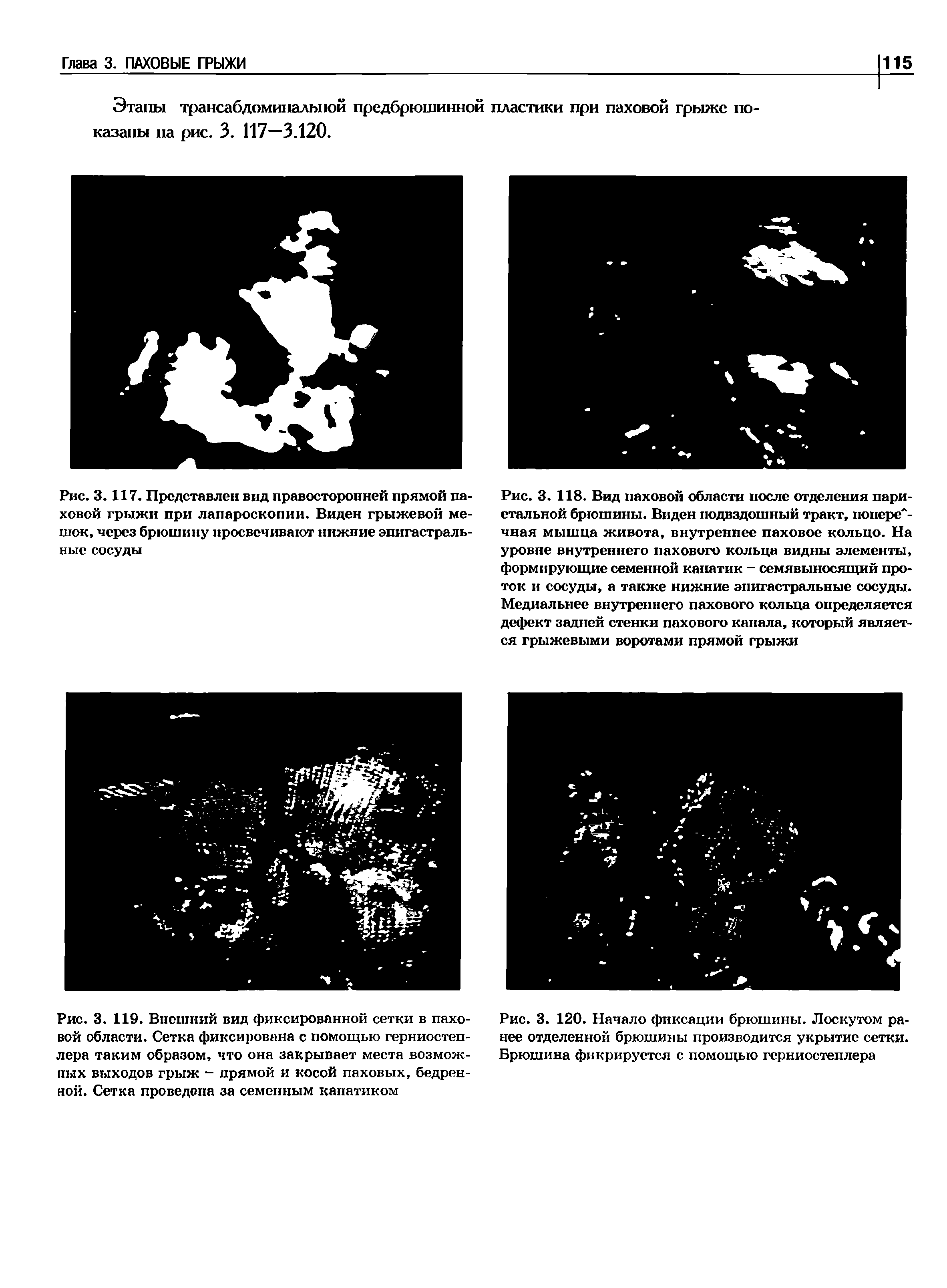 Рис. 3. 119. Внешний вид фиксированной сетки в паховой области. Сетка фиксирована с помощью герниостеп-лера таким образом, что она закрывает места возможных выходов грыж - прямой и косой паховых, бедренной. Сетка проведена за семенным канатиком...