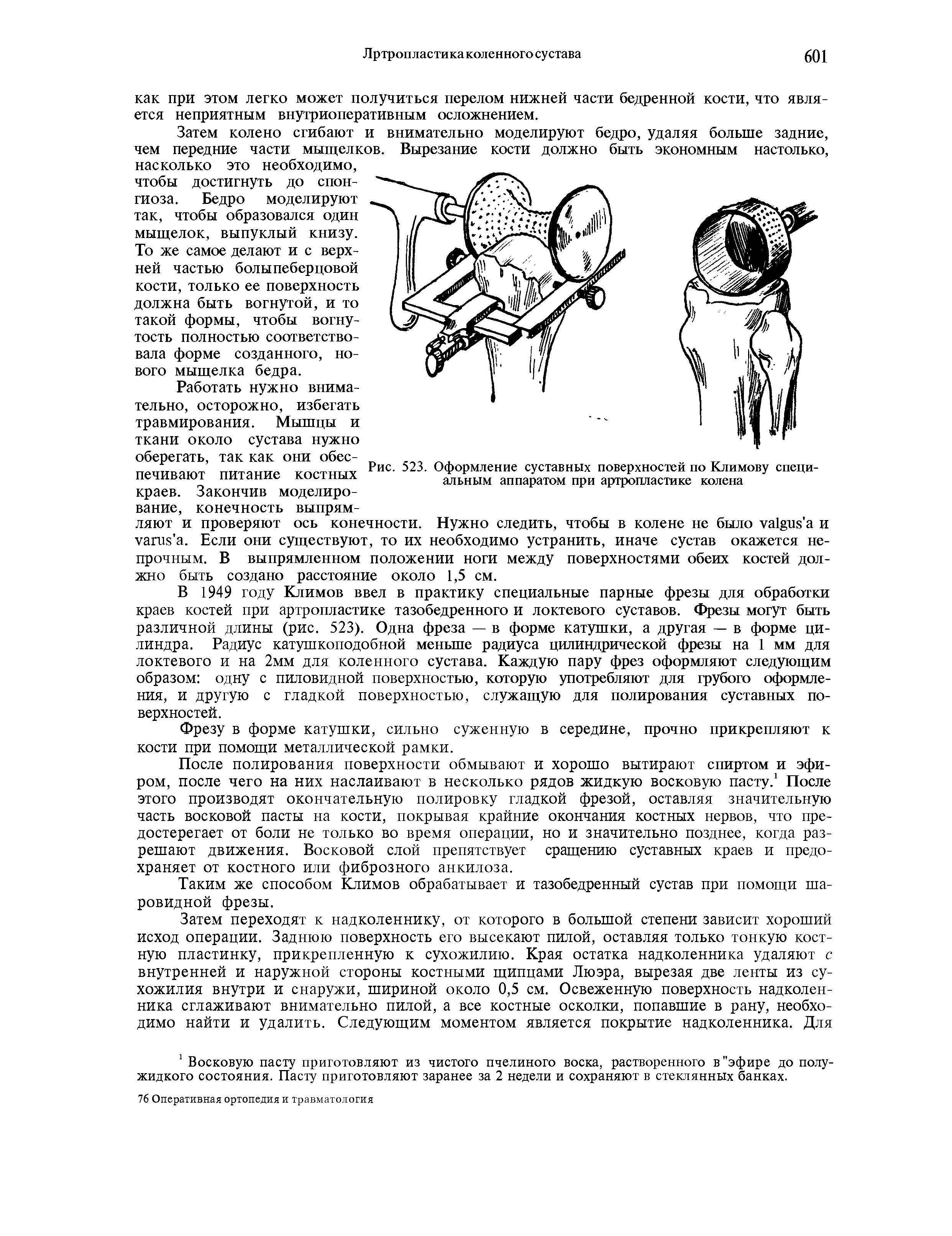 Рис. 523. Оформление суставных поверхностей по Климову специальным аппаратом при артропластике колена...