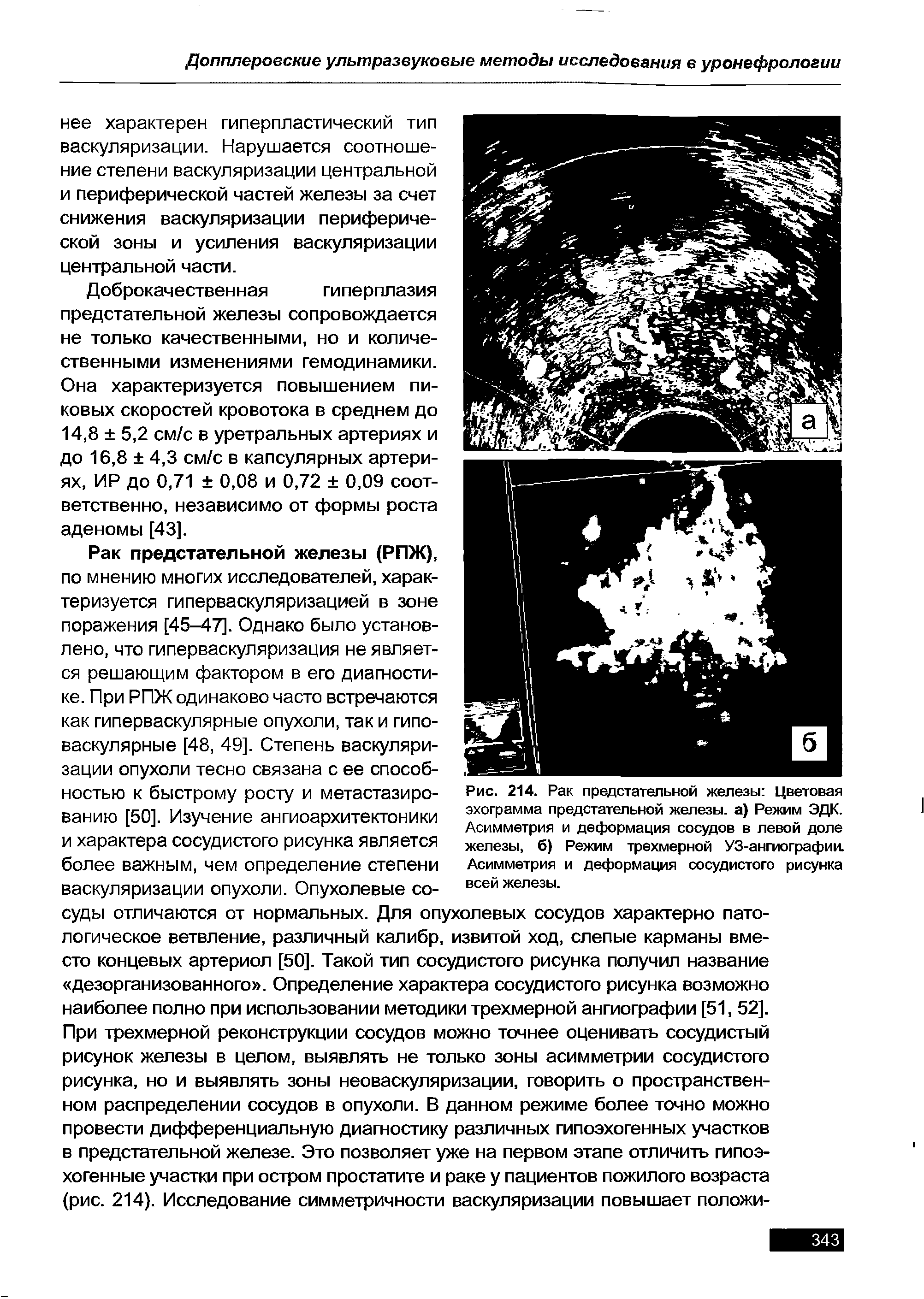 Рис. 214. Рак предстательной железы Цветовая эхограмма предстательной железы, а) Режим ЭДК. Асимметрия и деформация сосудов в левой доле железы, 6) Режим трехмерной УЗ-ангиографии. Асимметрия и деформация сосудистого рисунка всей железы.